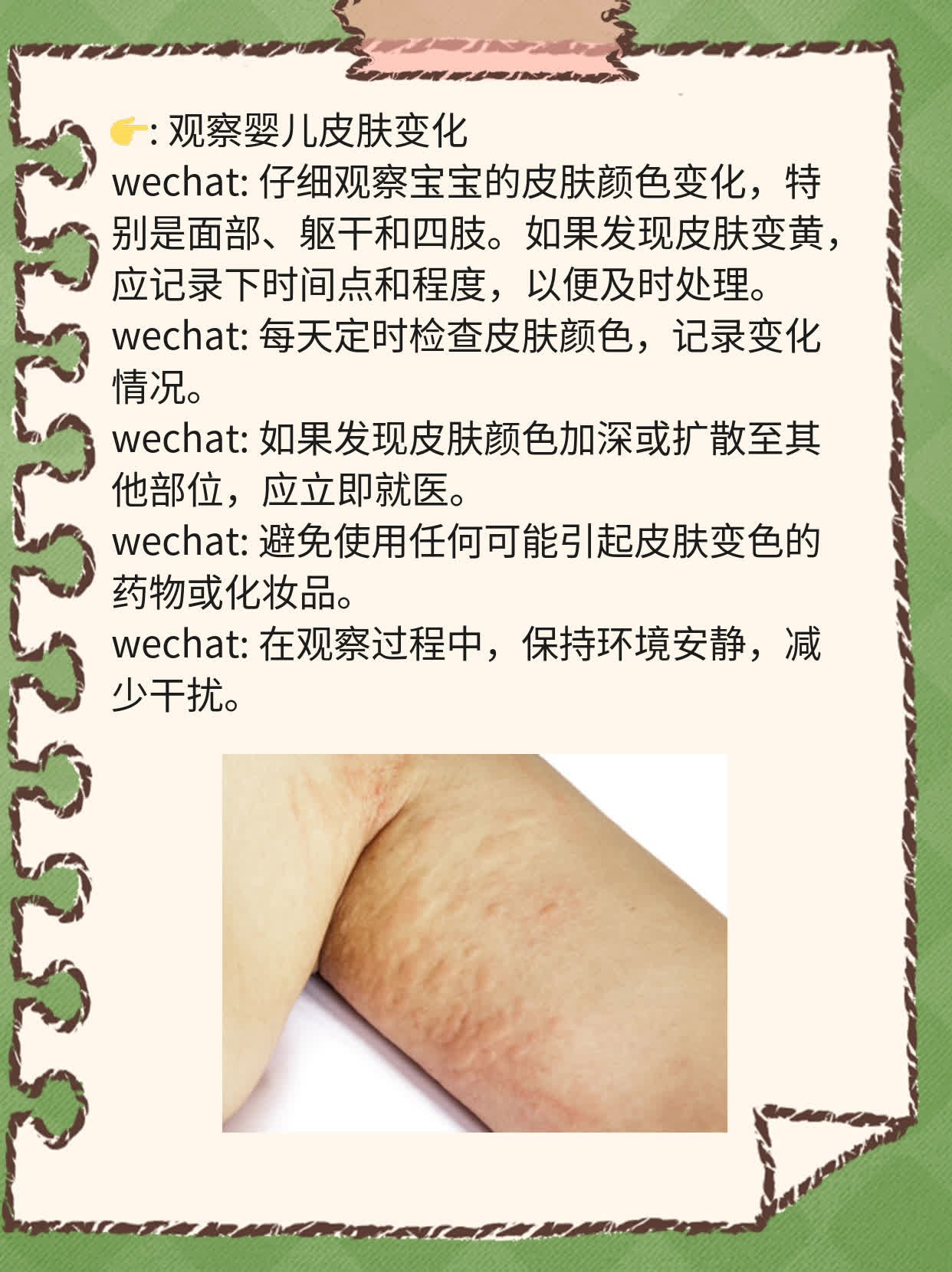 新手爸妈必看：新生儿黄疸的症状解析