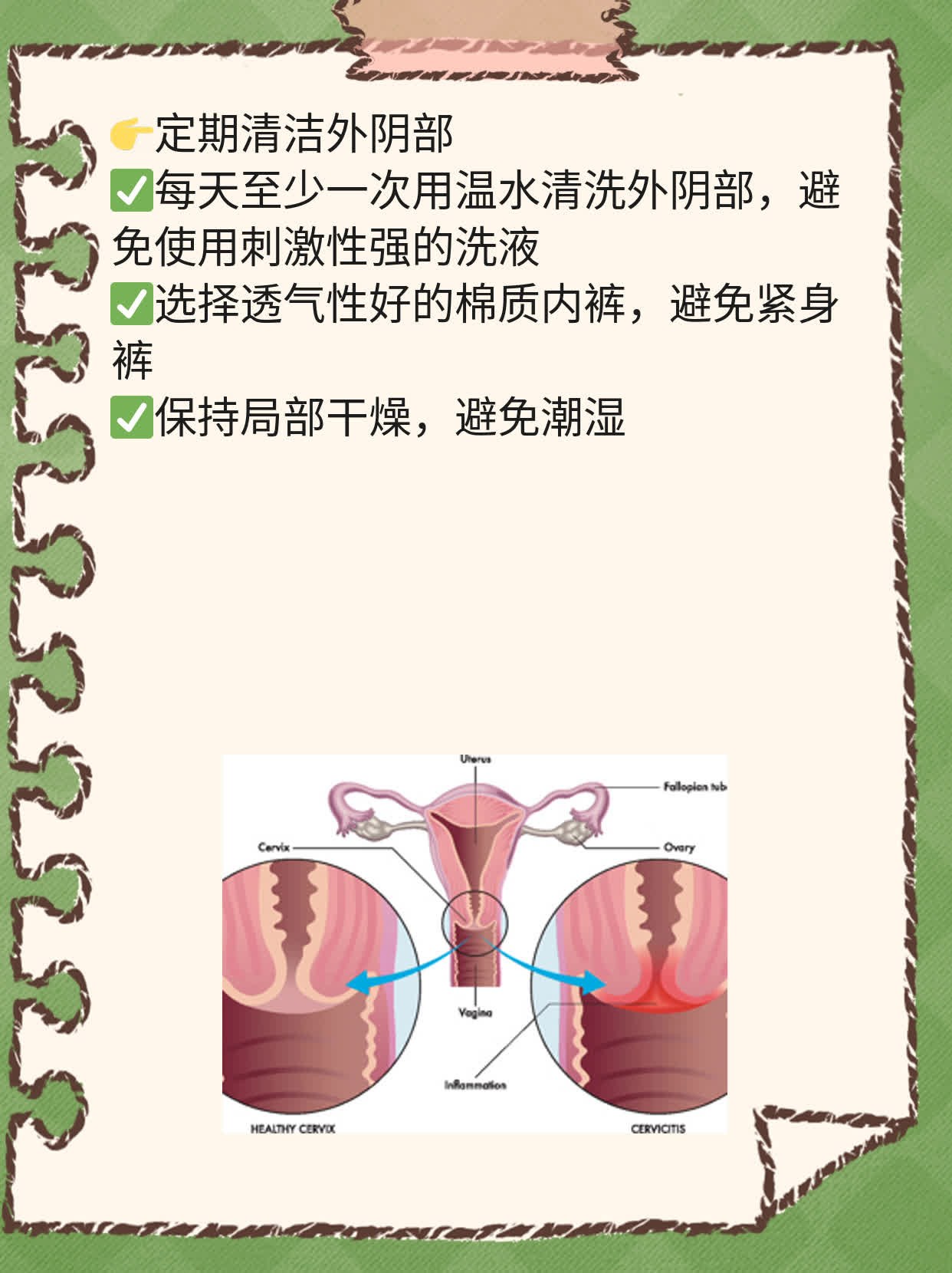 「揭秘」女性泌尿道感染诱因