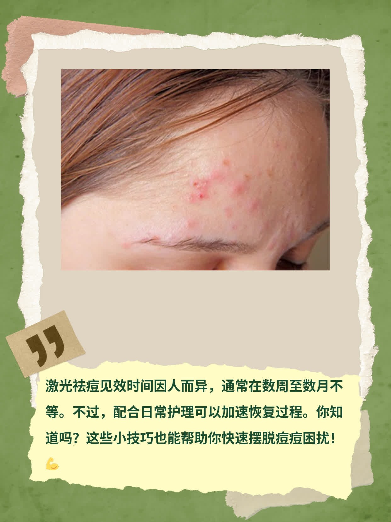 揭秘激光祛痘见效时间！