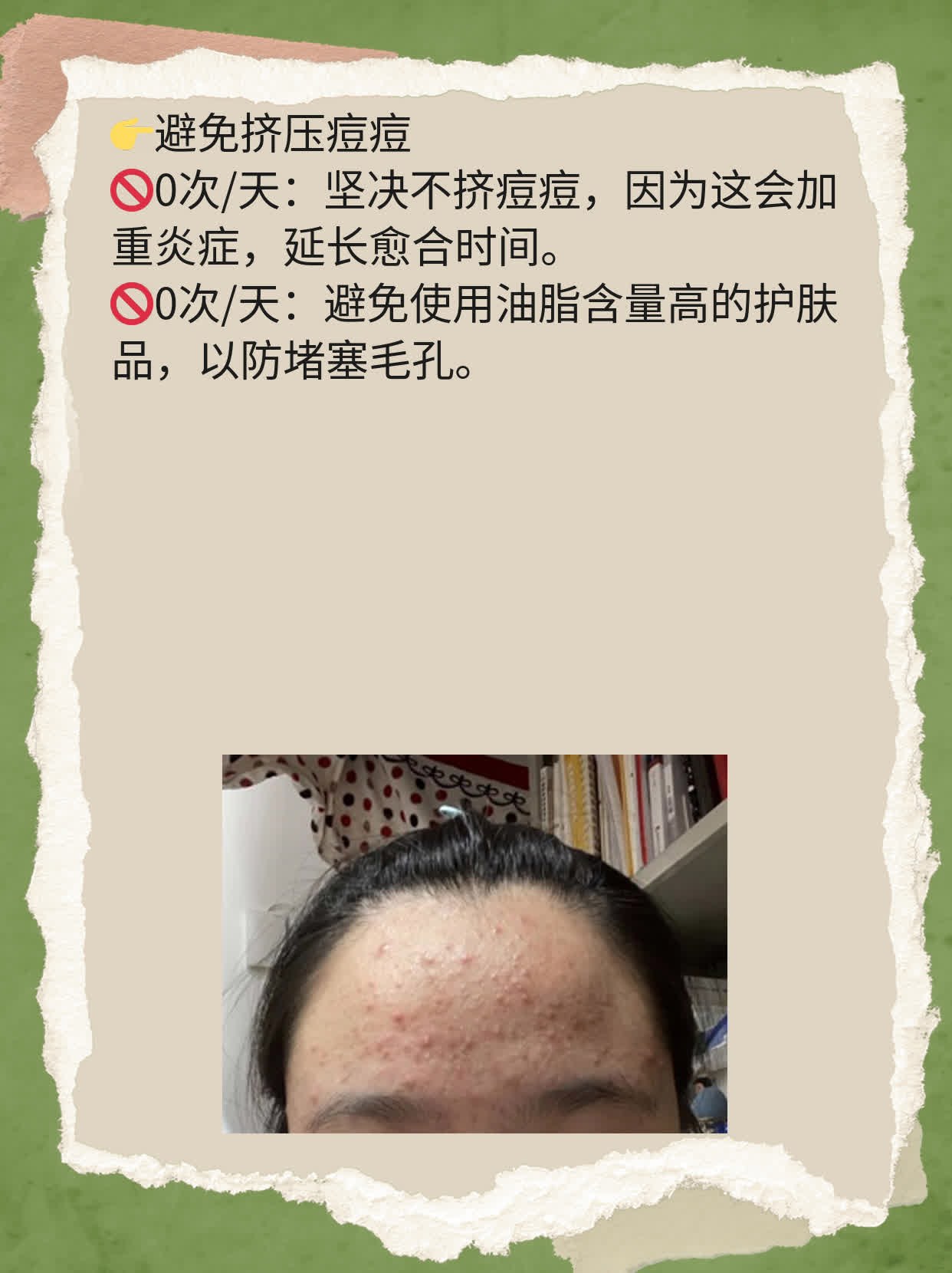 揭秘激光祛痘见效时间！