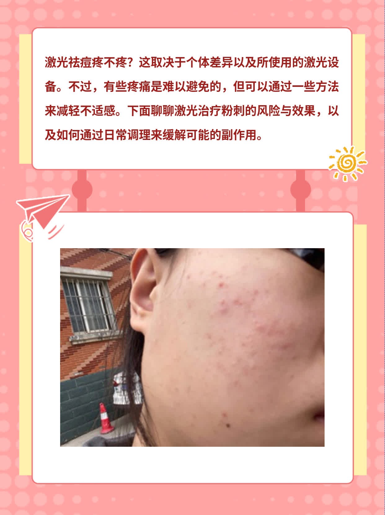 激光祛痘疼不疼？聊聊激光治疗粉刺的风险与效果！