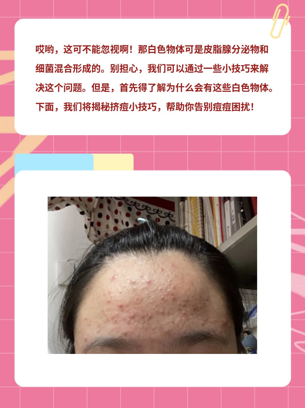 探秘：挤出的白物是啥？——挤痘小技巧大揭秘！