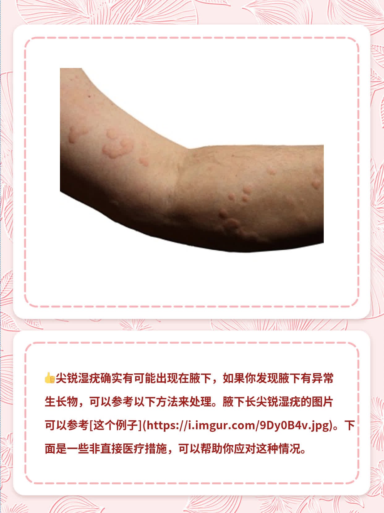 「有图有真相」腋下长尖锐湿疣是这样子的！