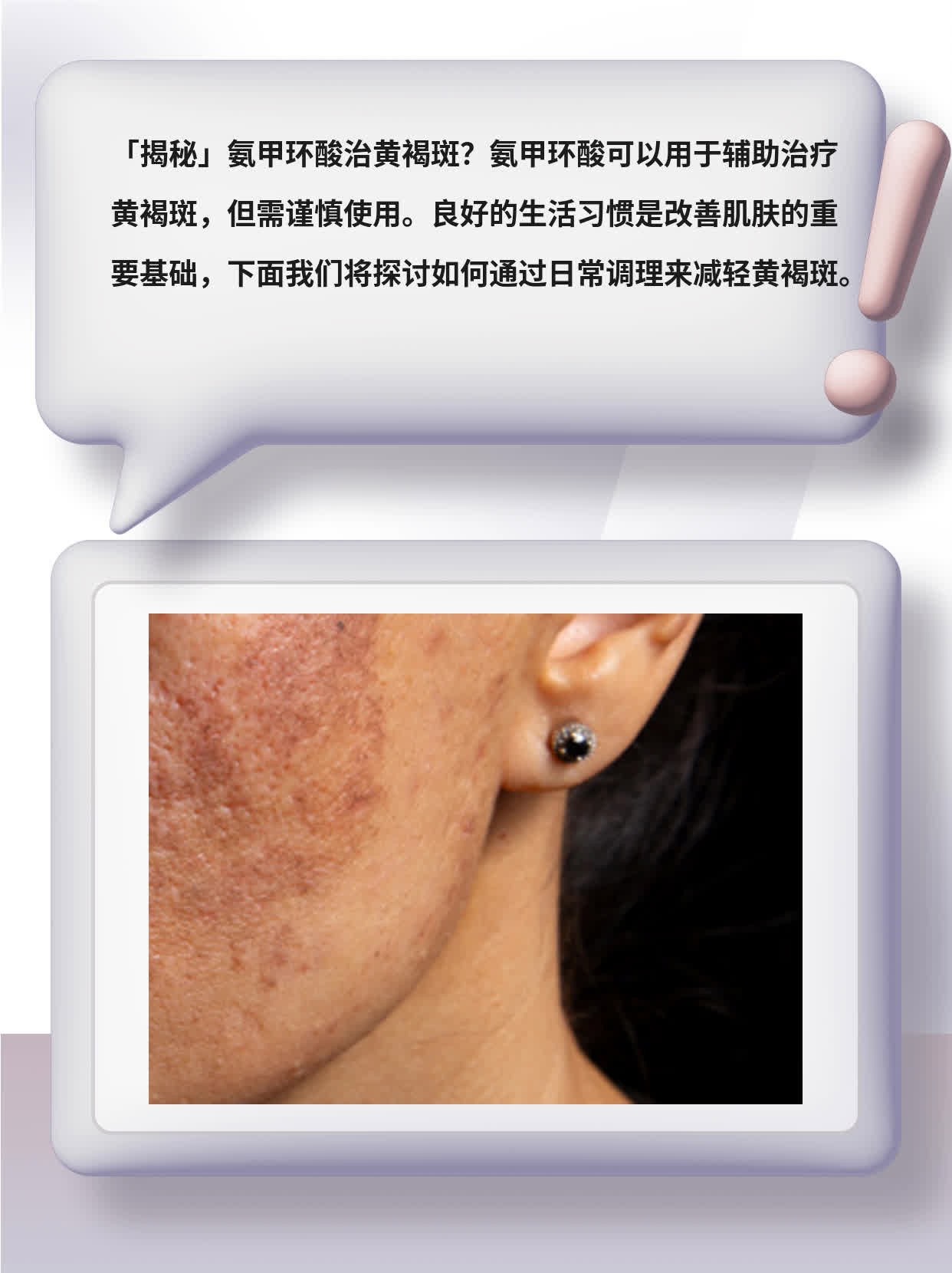 「揭秘」氨甲环酸治黄褐斑？