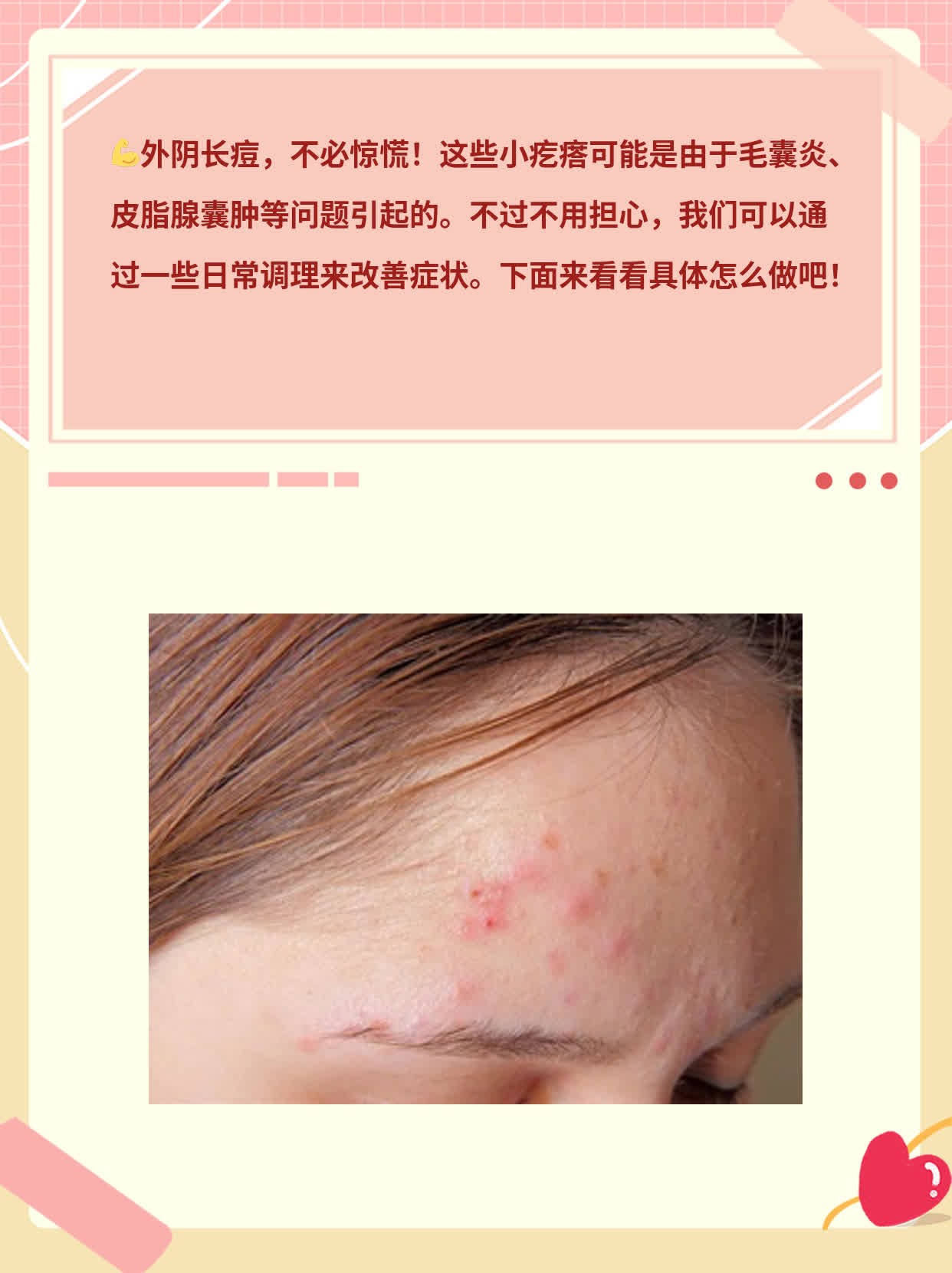 「外阴长痘」原因揭秘：如何解决小烦恼？