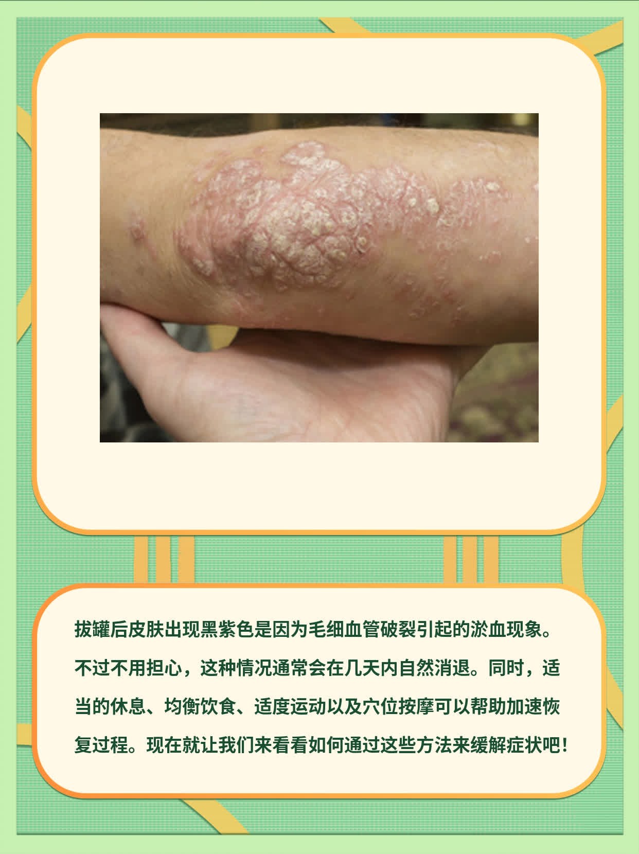 拔罐后皮肤变黑紫，原因揭秘！