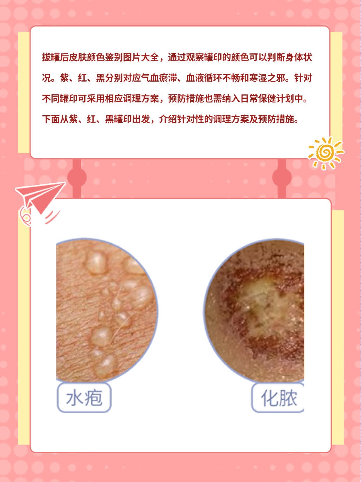 「看懂罐印」：拔罐后皮肤颜色鉴别的图解指南