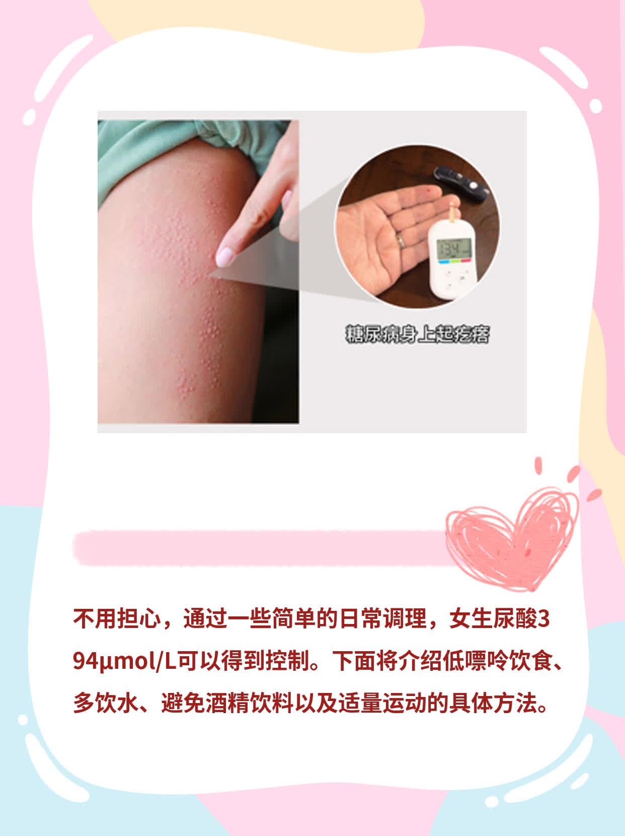 女生尿酸394μmol/L算不算高？