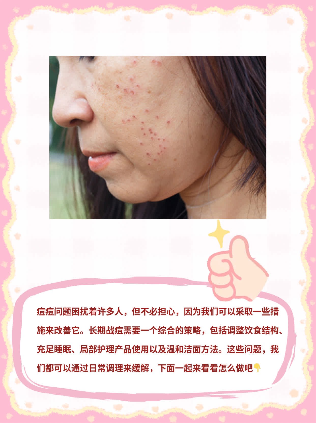 告别脸上的烦恼：长期战痘攻略！