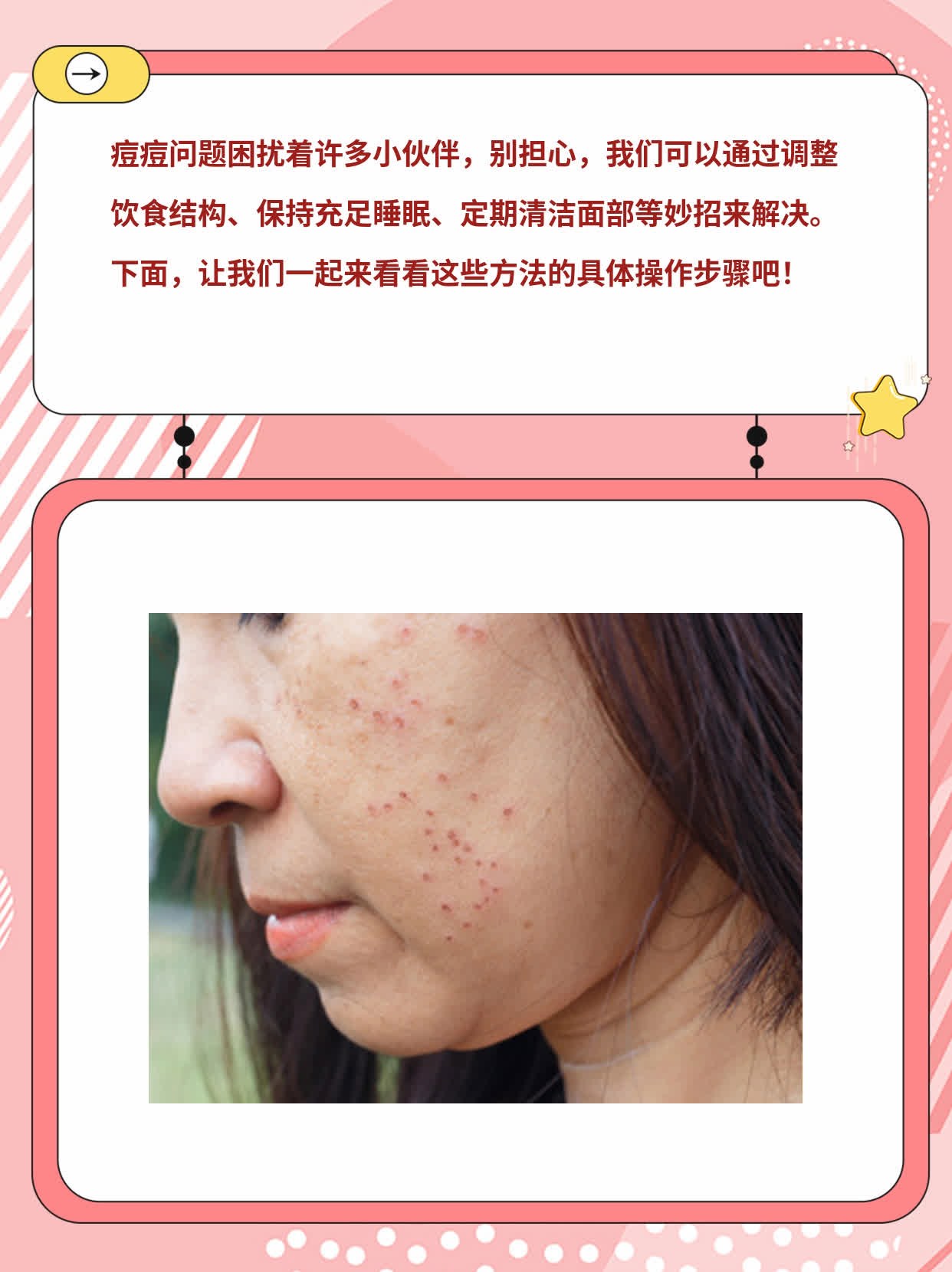 告别脸上的烦恼：处理痘痘的妙招！