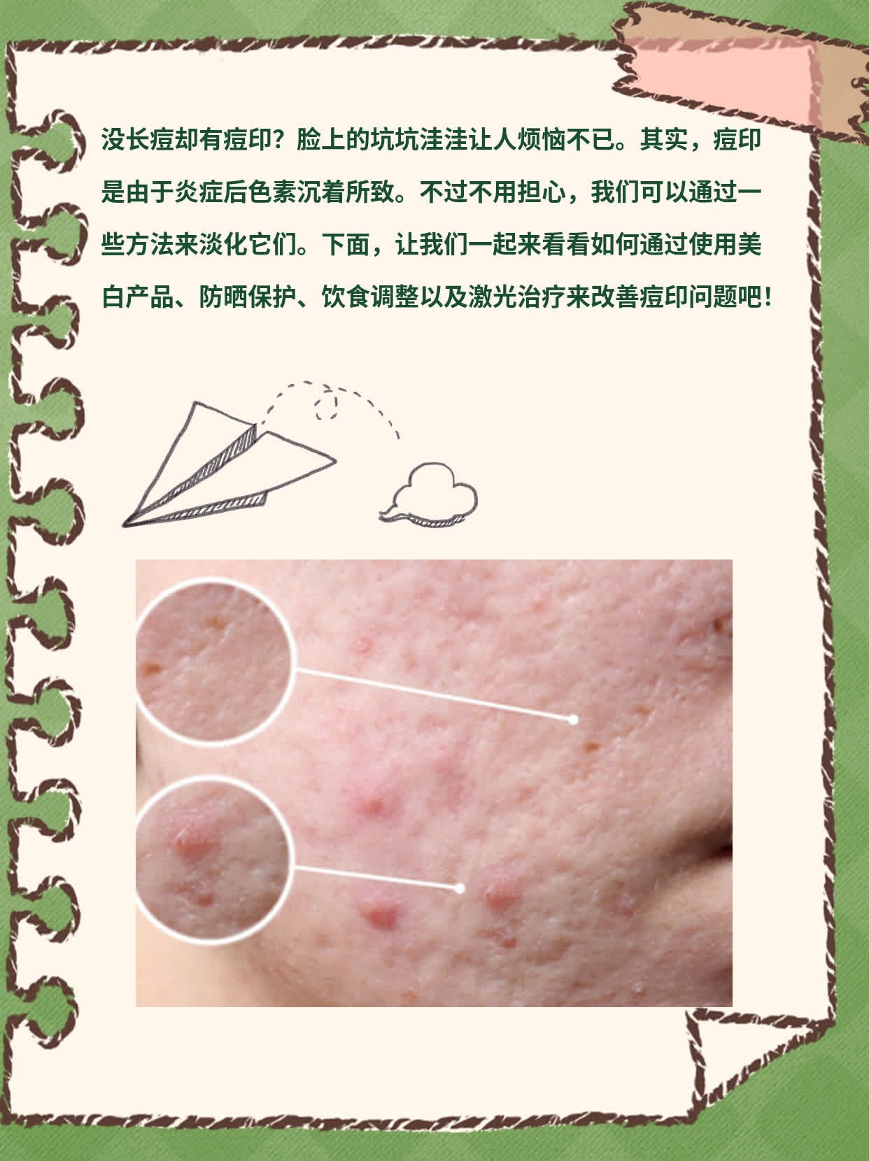 没长痘却有痘印？揭秘脸坑形成原因！