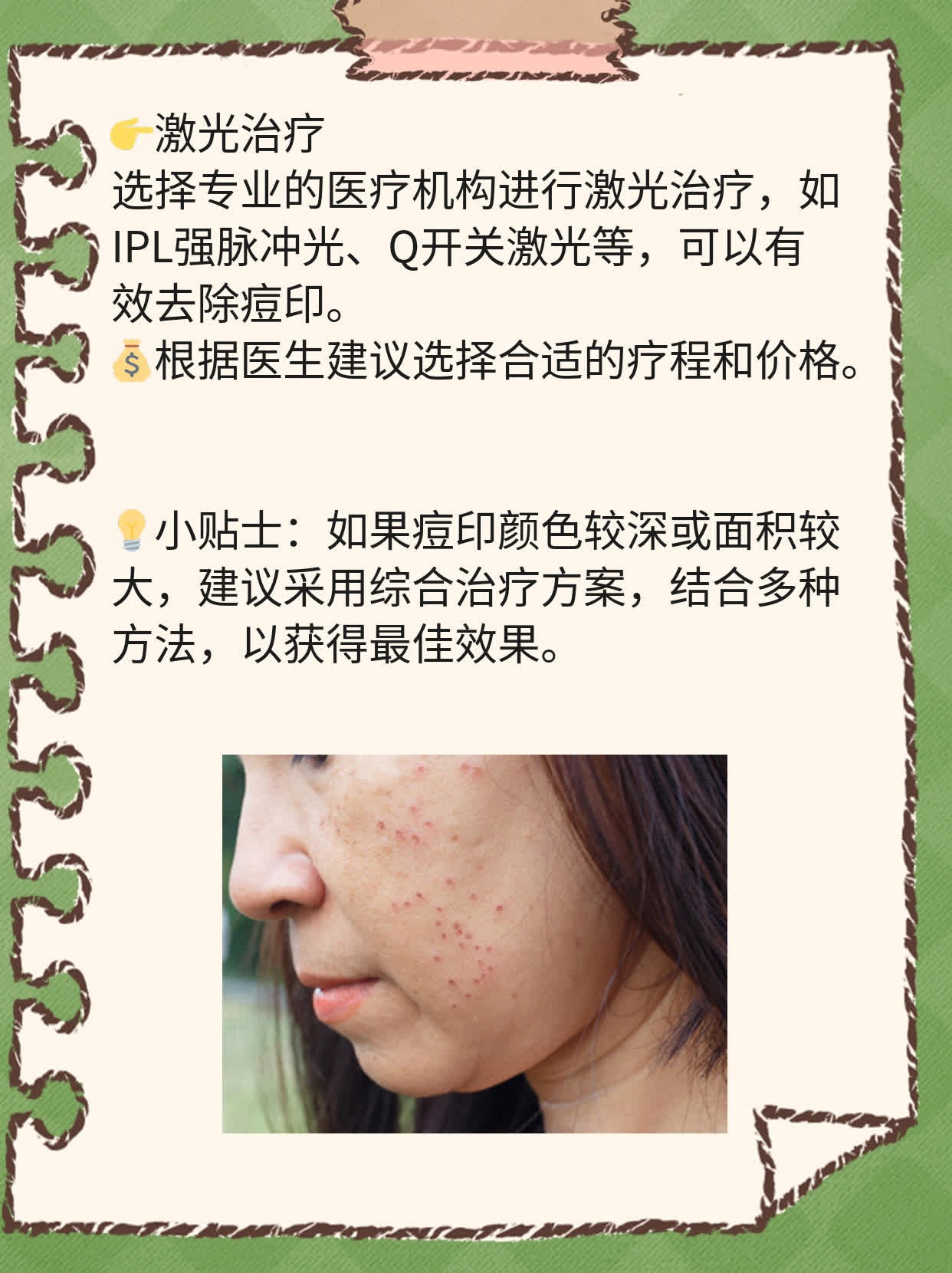 没长痘却有痘印？揭秘脸坑形成原因！
