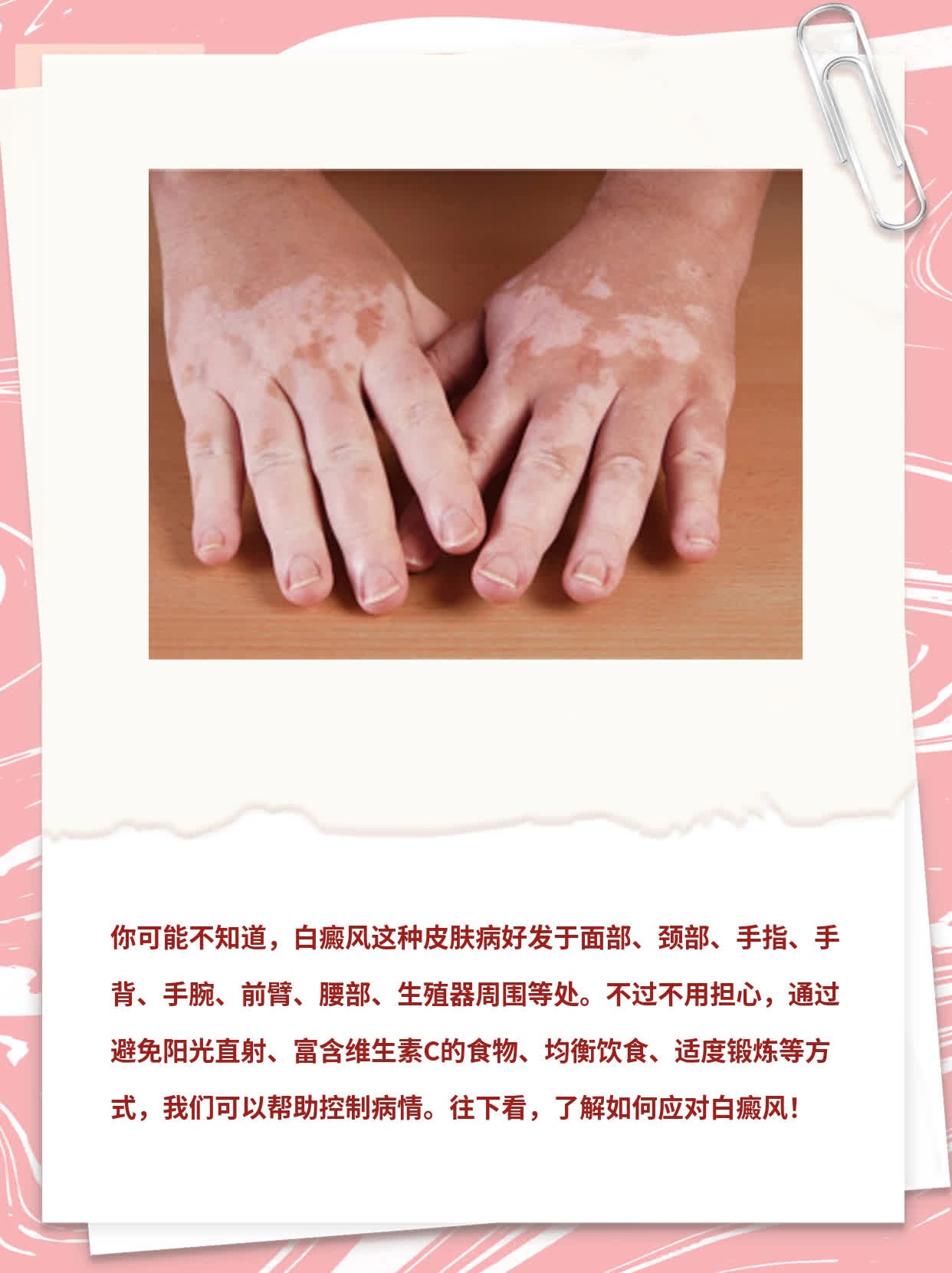 「揭秘」白癜风好发于这些部位！