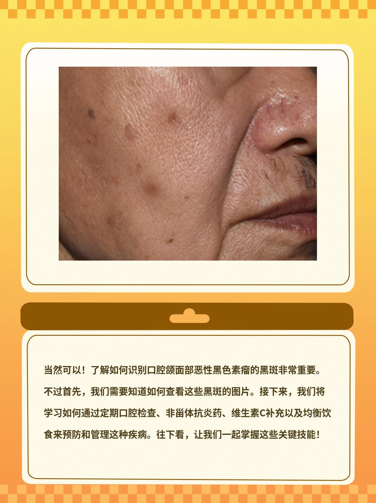「有图有真相」：口腔颌面部恶性黑色素瘤的黑斑识别指南