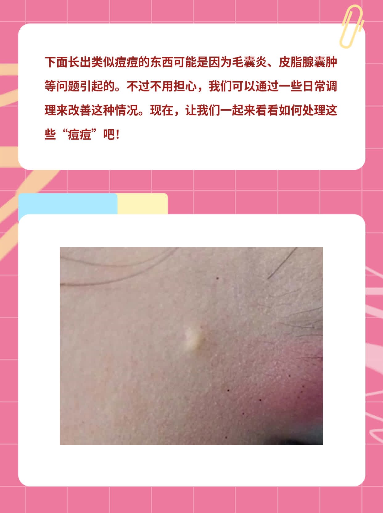 下面长出类似痘痘的东西？探寻背后原因及处理方法！