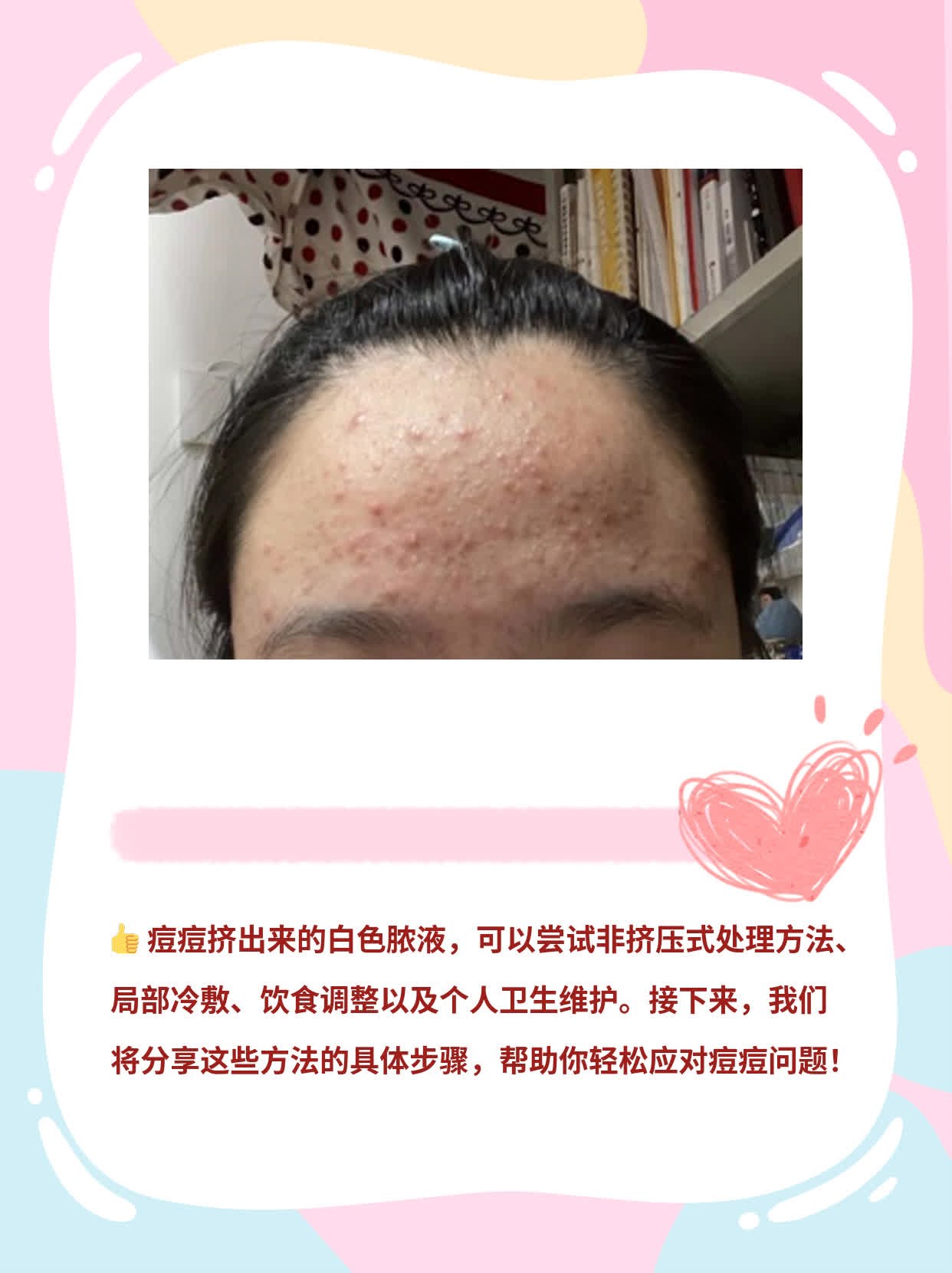 「有图有真相」处理挤出白脓的痘痘攻略