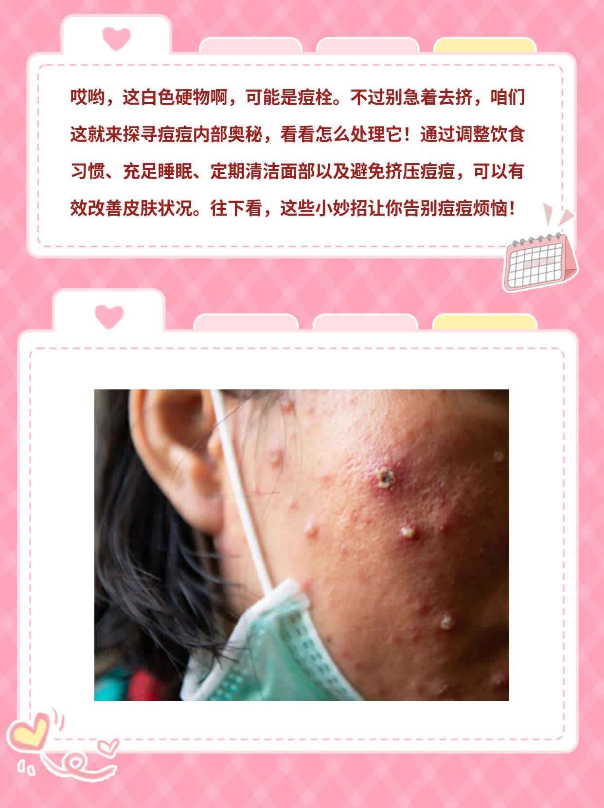 挤出白色硬物是痘栓吗？探寻痘痘内部奥秘！