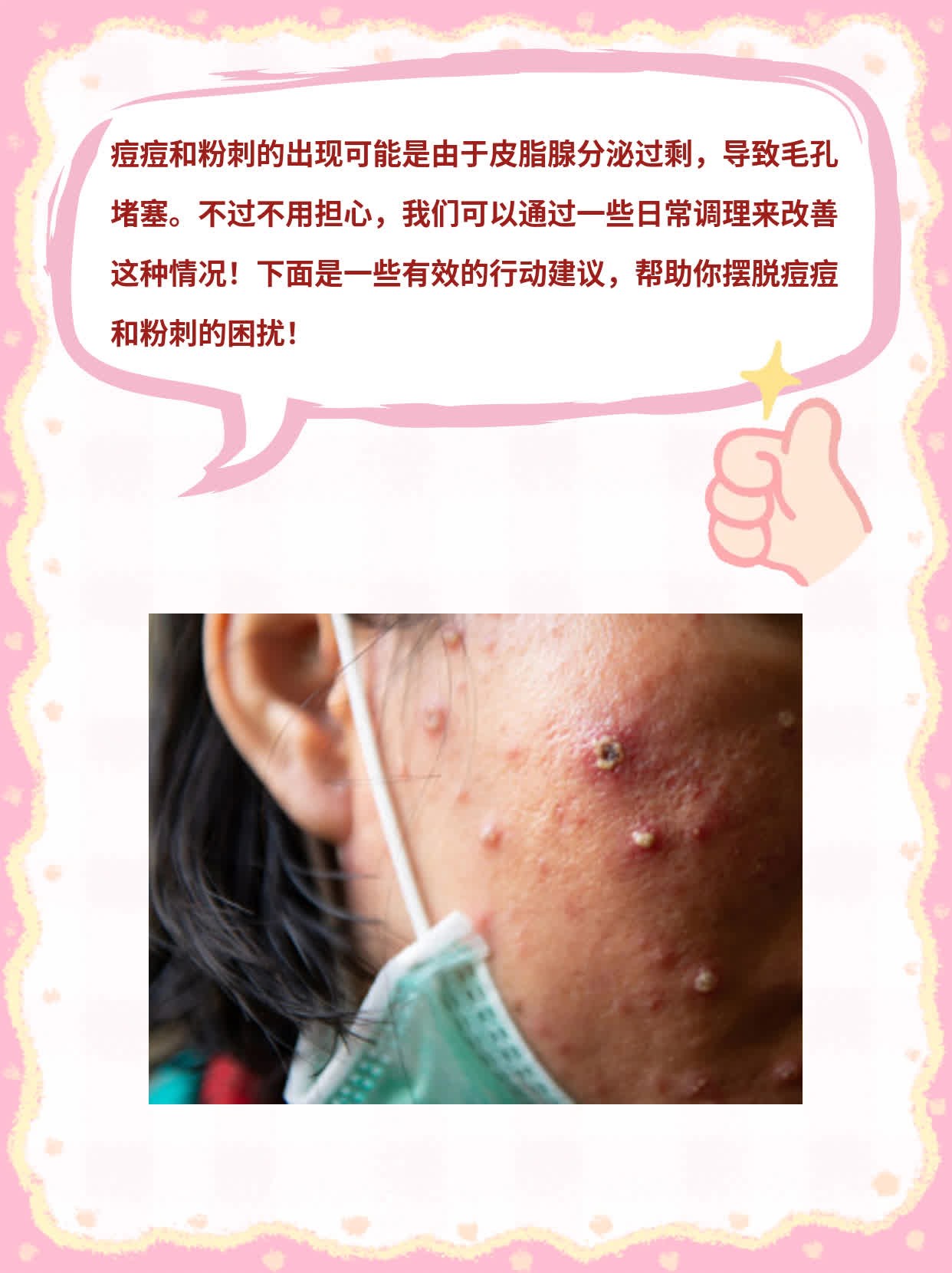 揭秘：脸上的痘痘和粉刺元凶！