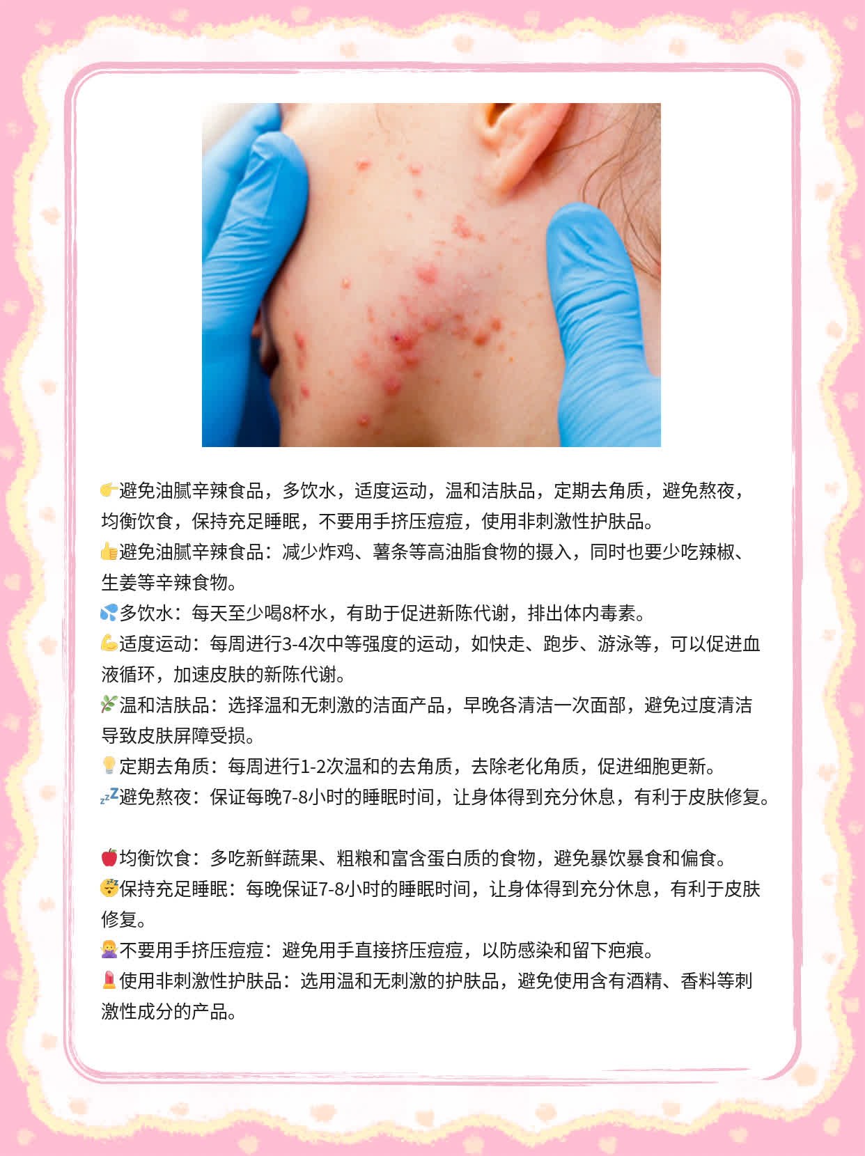 揭秘：脸上的痘痘和粉刺元凶！
