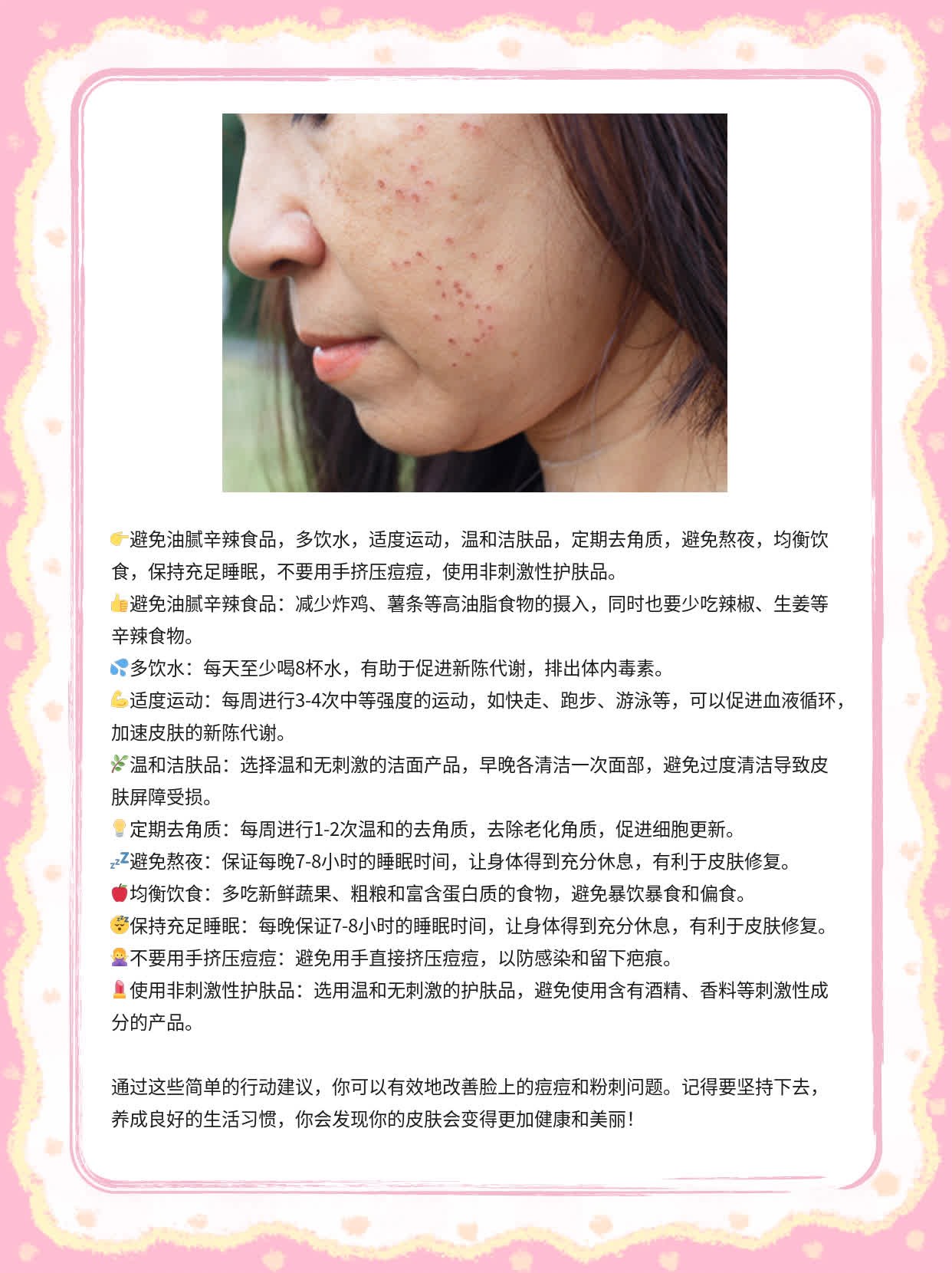 揭秘：脸上的痘痘和粉刺元凶！