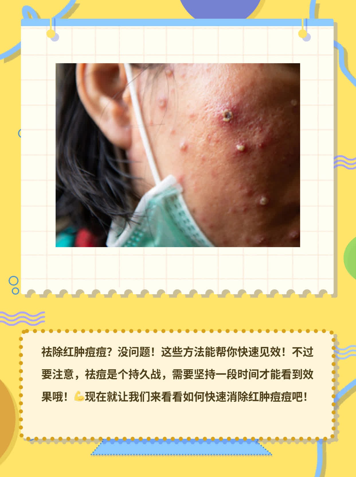 祛痘神器！快速消除红肿痘痘的方法