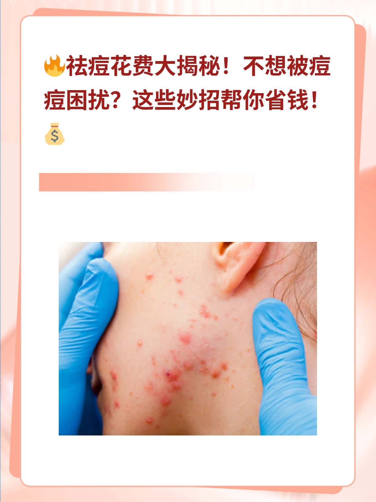 「祛痘花费」——医院战“痘”价格全攻略！