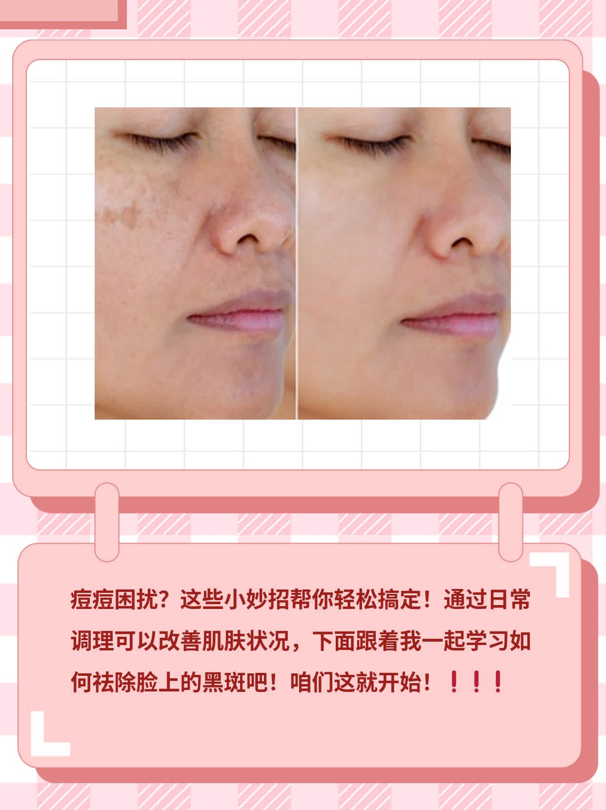 祛除脸上的黑斑：简单有效的方法分享！