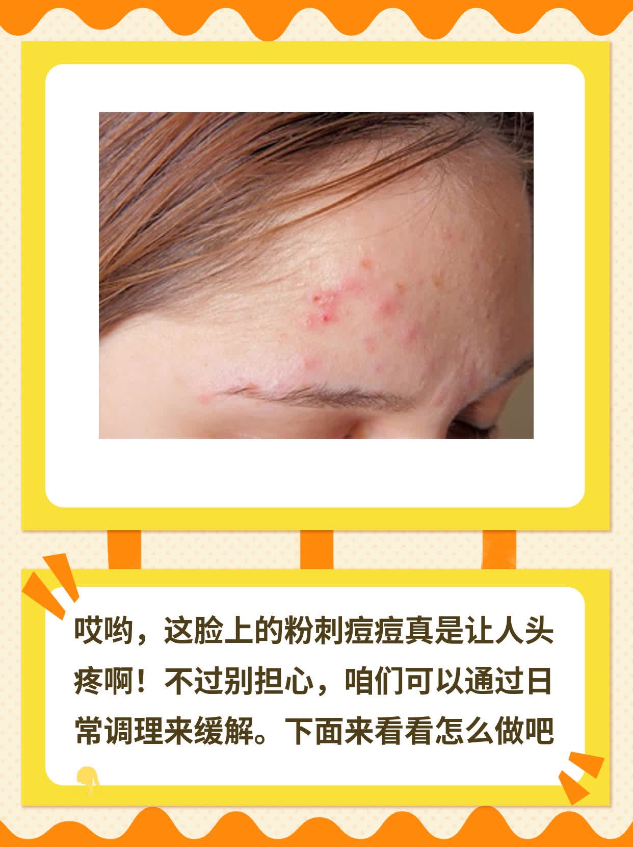 揭秘：脸上的粉刺痘痘为何频现？