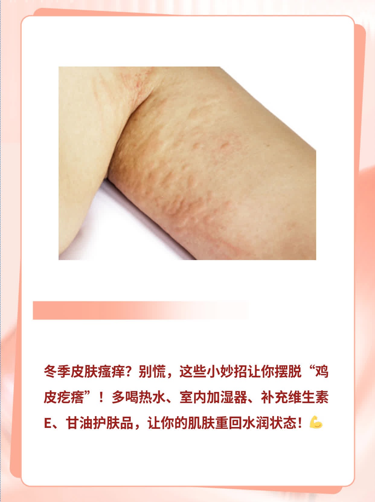 「冬季皮肤瘙痒」小妙招：拯救你的「鸡皮疙瘩」！