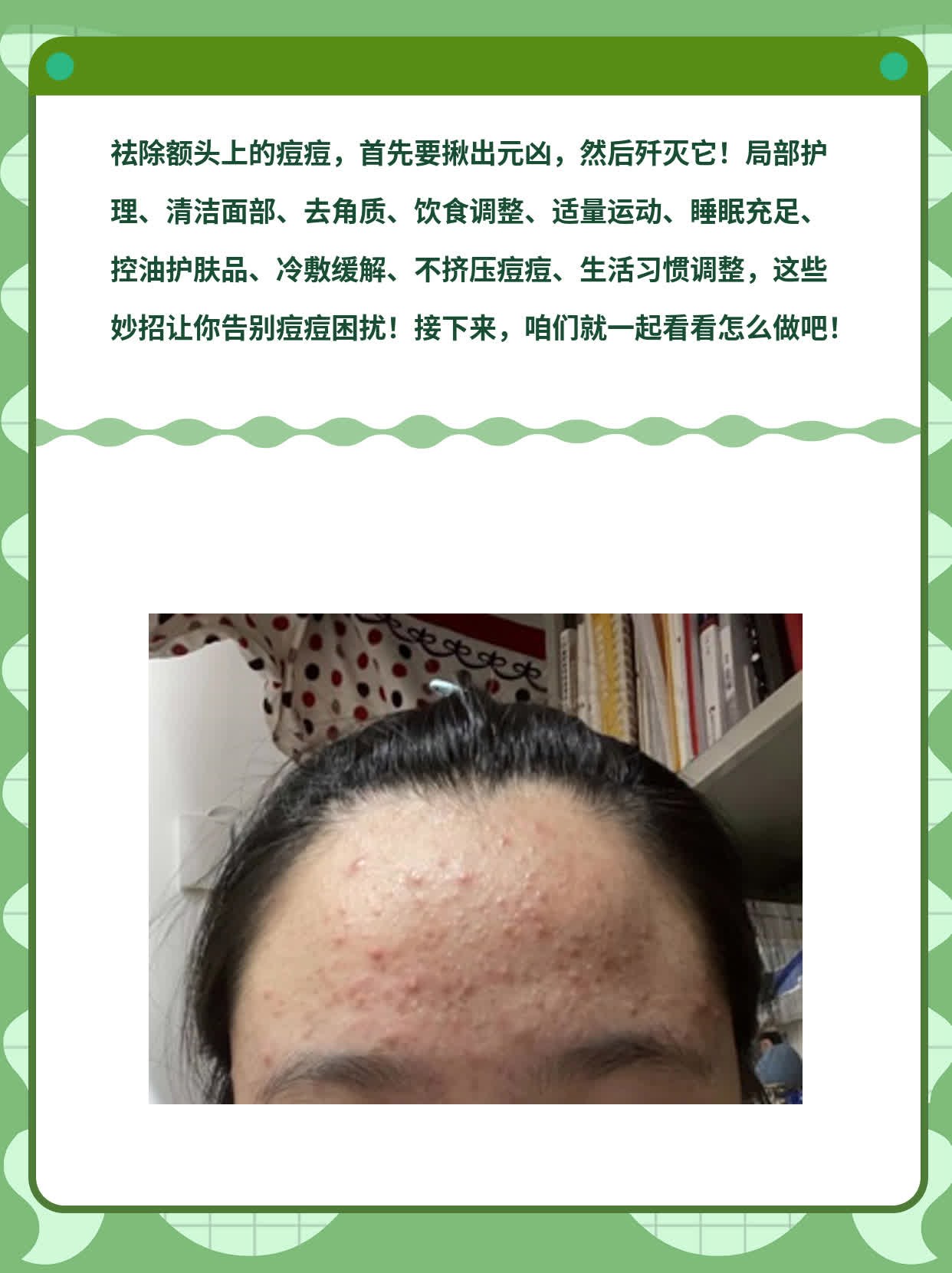 「祛痘妙招」：揪出额头上痘痘的元凶并歼灭它！