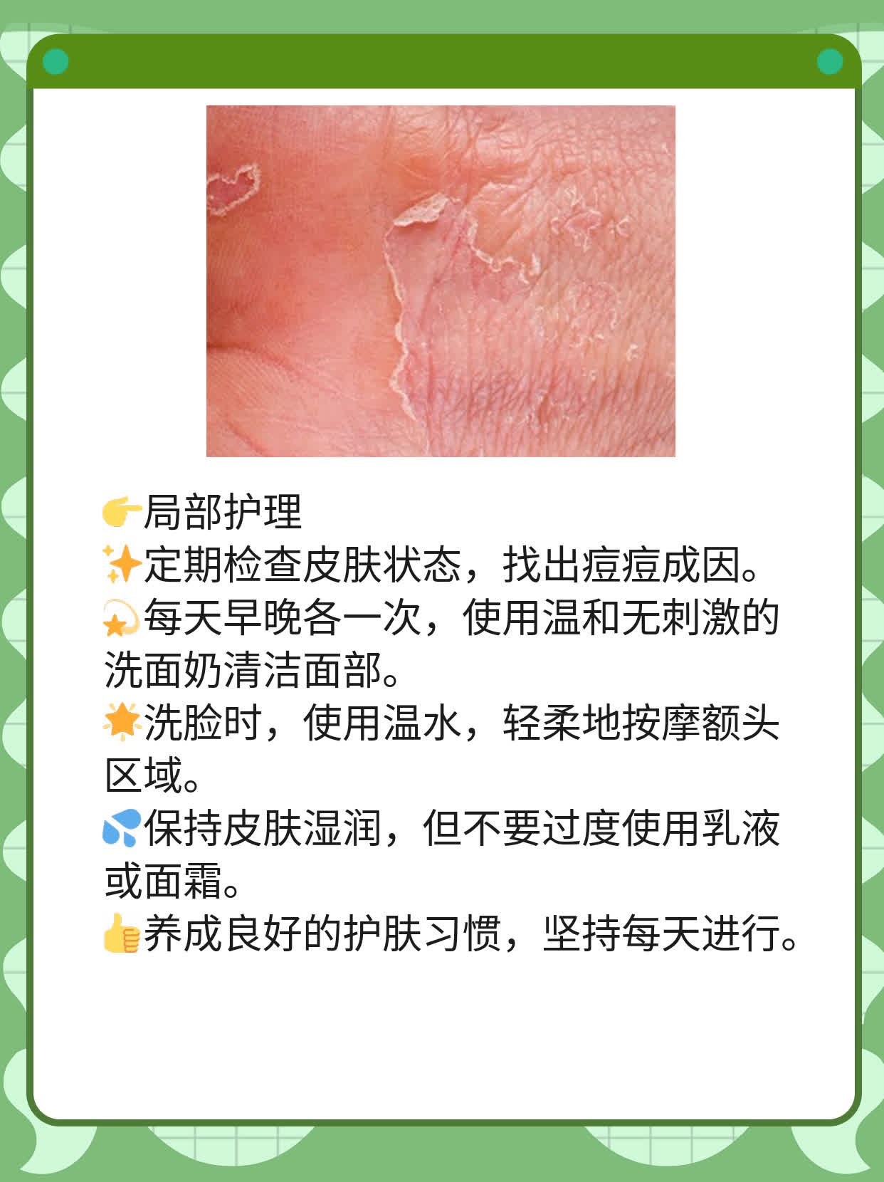 「祛痘妙招」：揪出额头上痘痘的元凶并歼灭它！