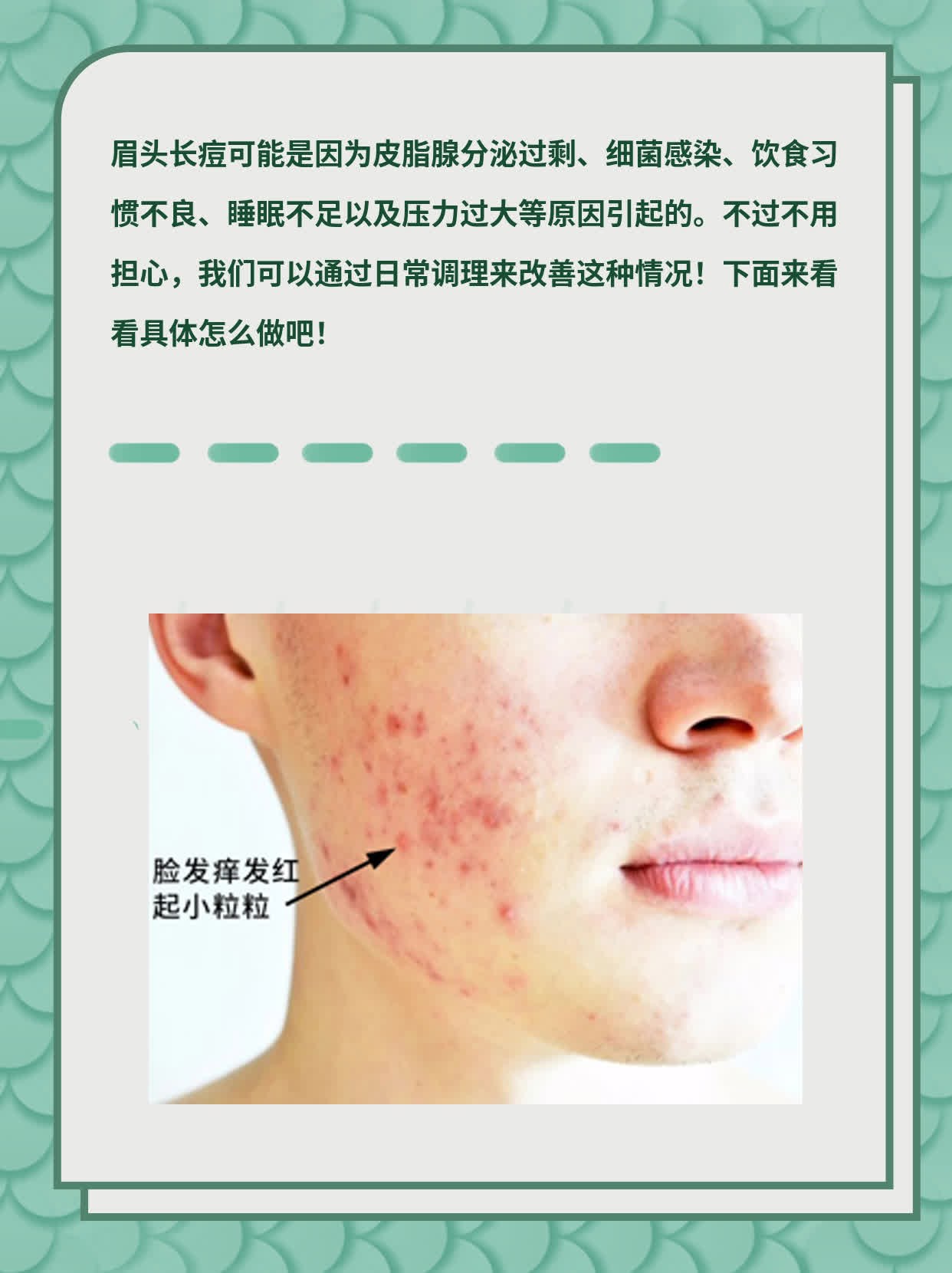 「眉头长痘」：探究背后的原因及解决方法！