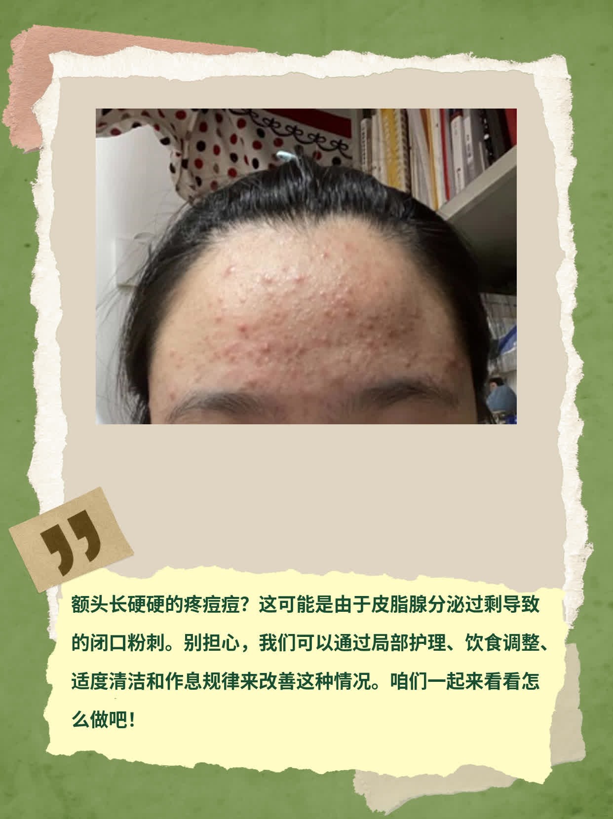 额头上长硬硬的疼痘痘？