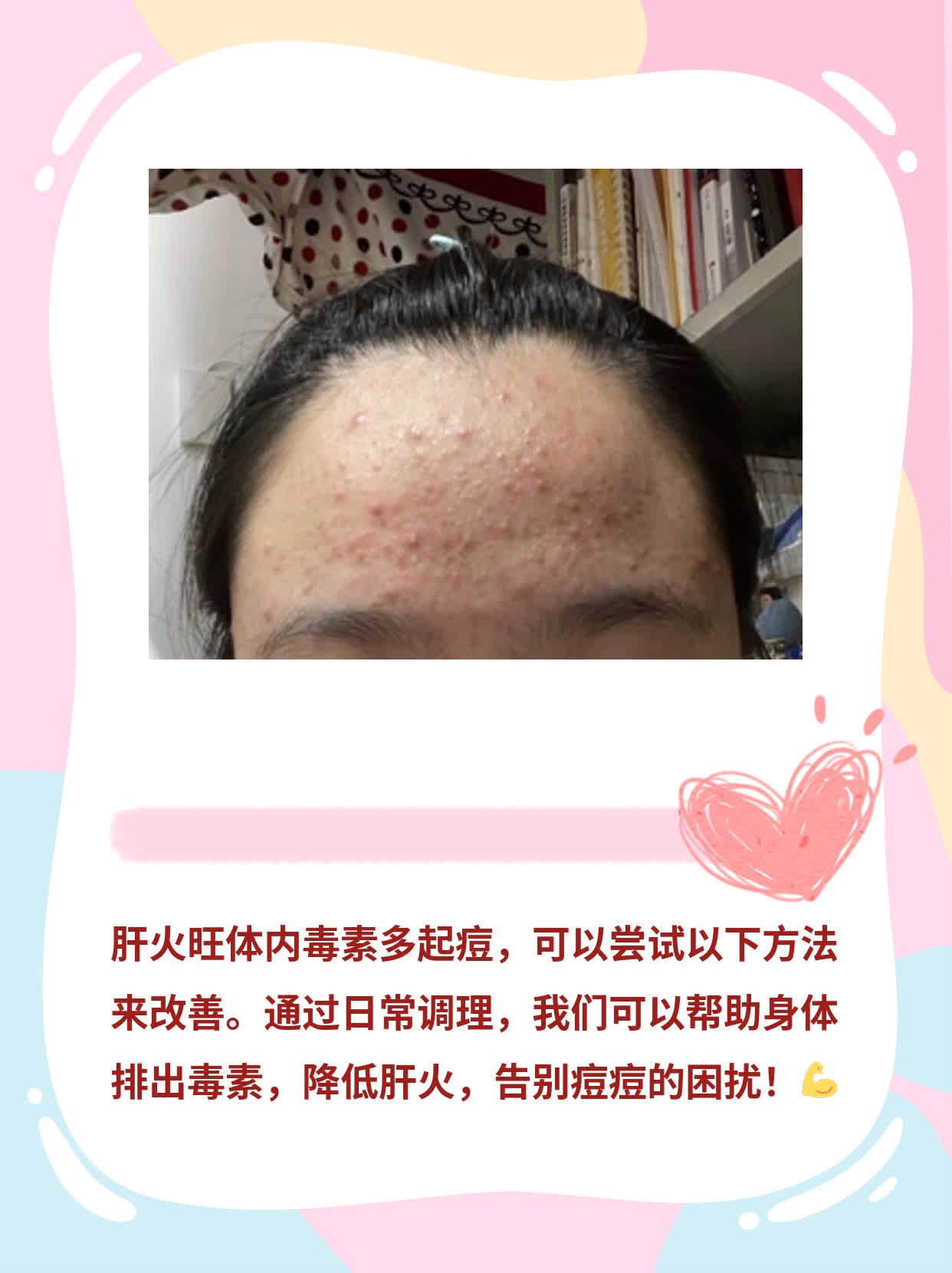 排毒降肝火，告别痘痘烦恼！