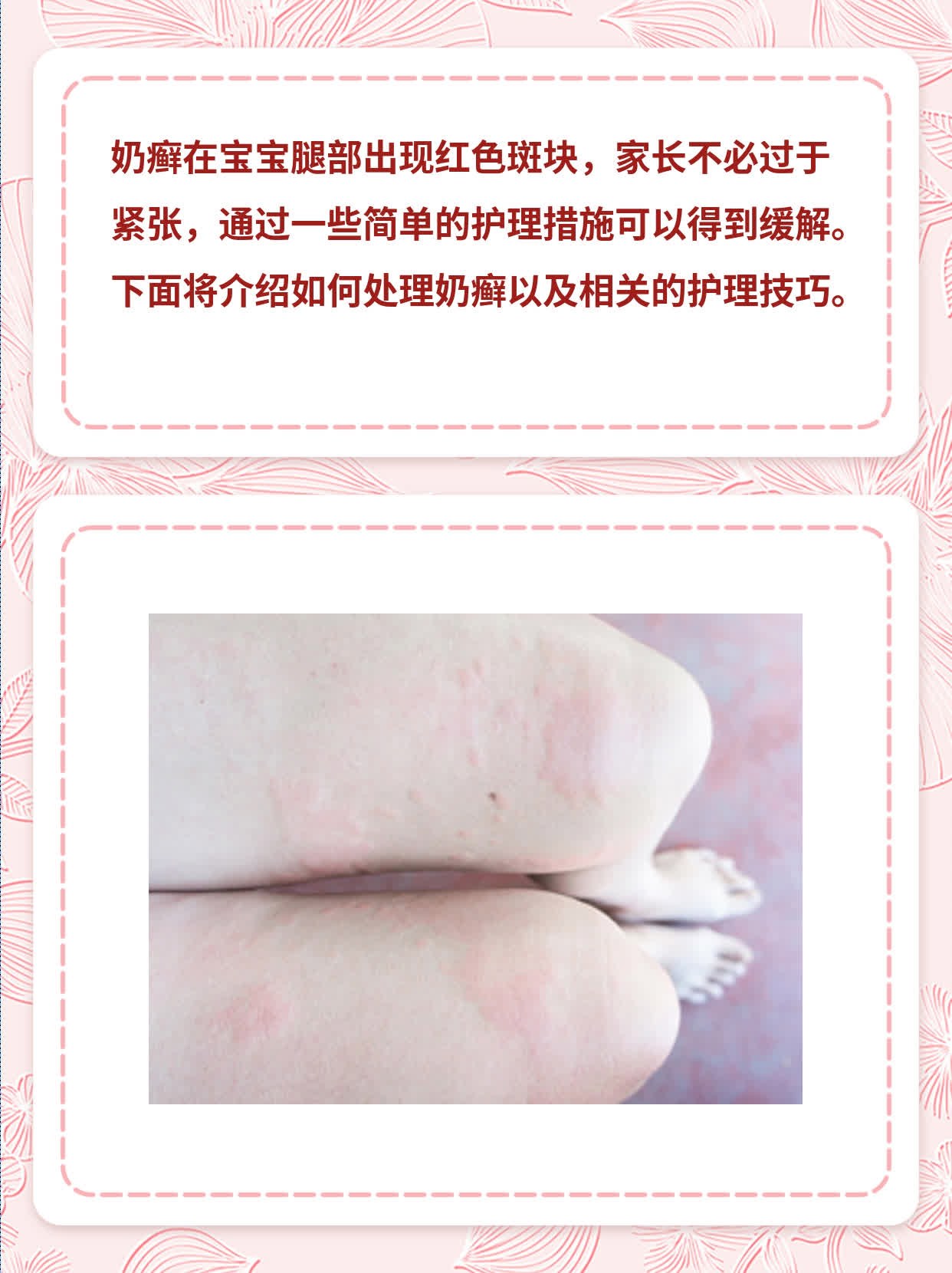 宝宝奶癣：腿部红斑图解及护理技巧