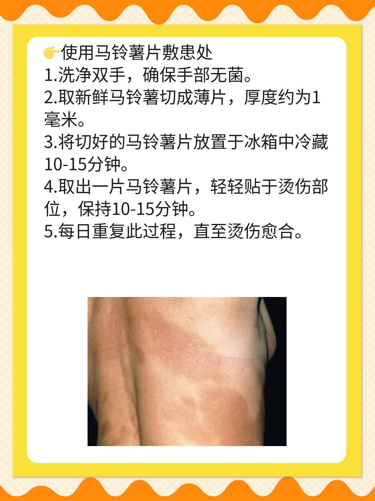 「祛疤妙招」：应对烫伤后遗留瘢痕的急救指南