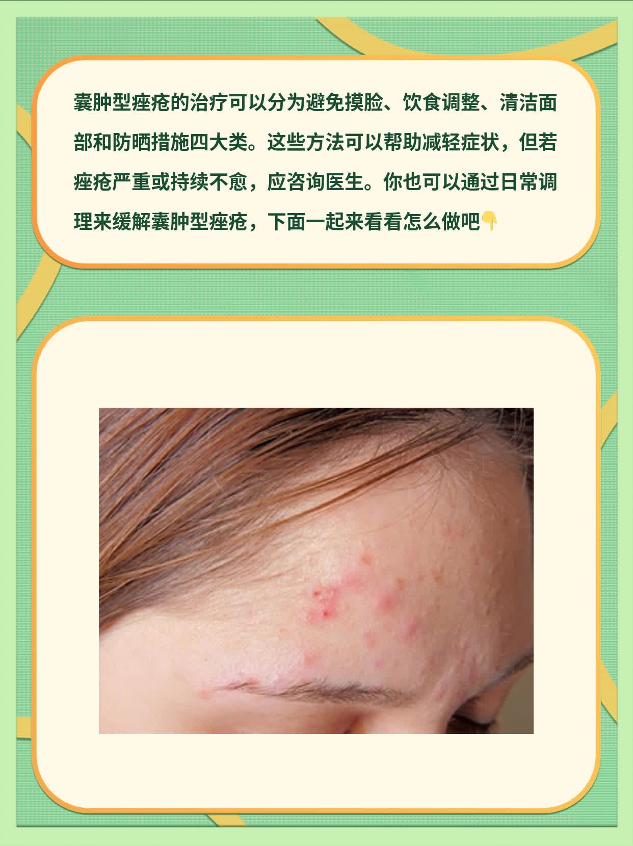 囊肿型痤疮的治疗方法大全！