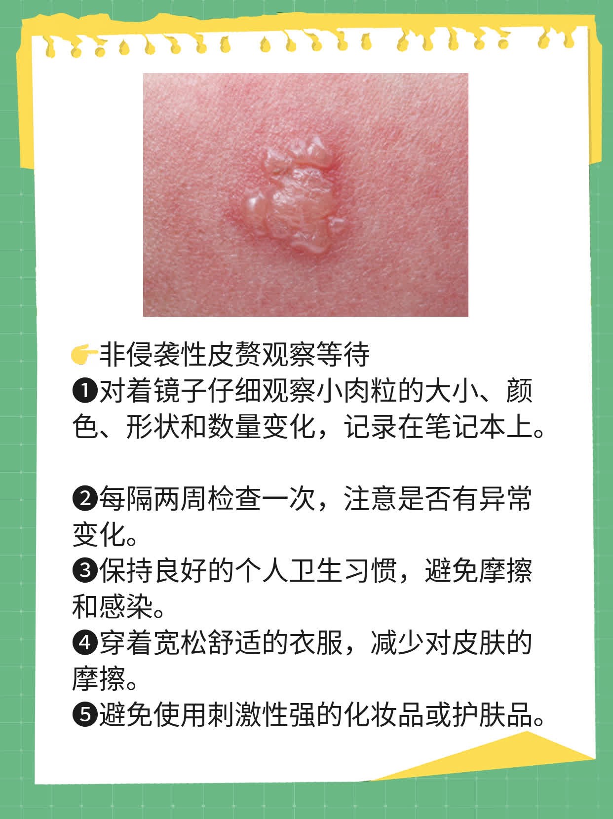 小肉粒困扰？揭秘身体上的皮肤问题！