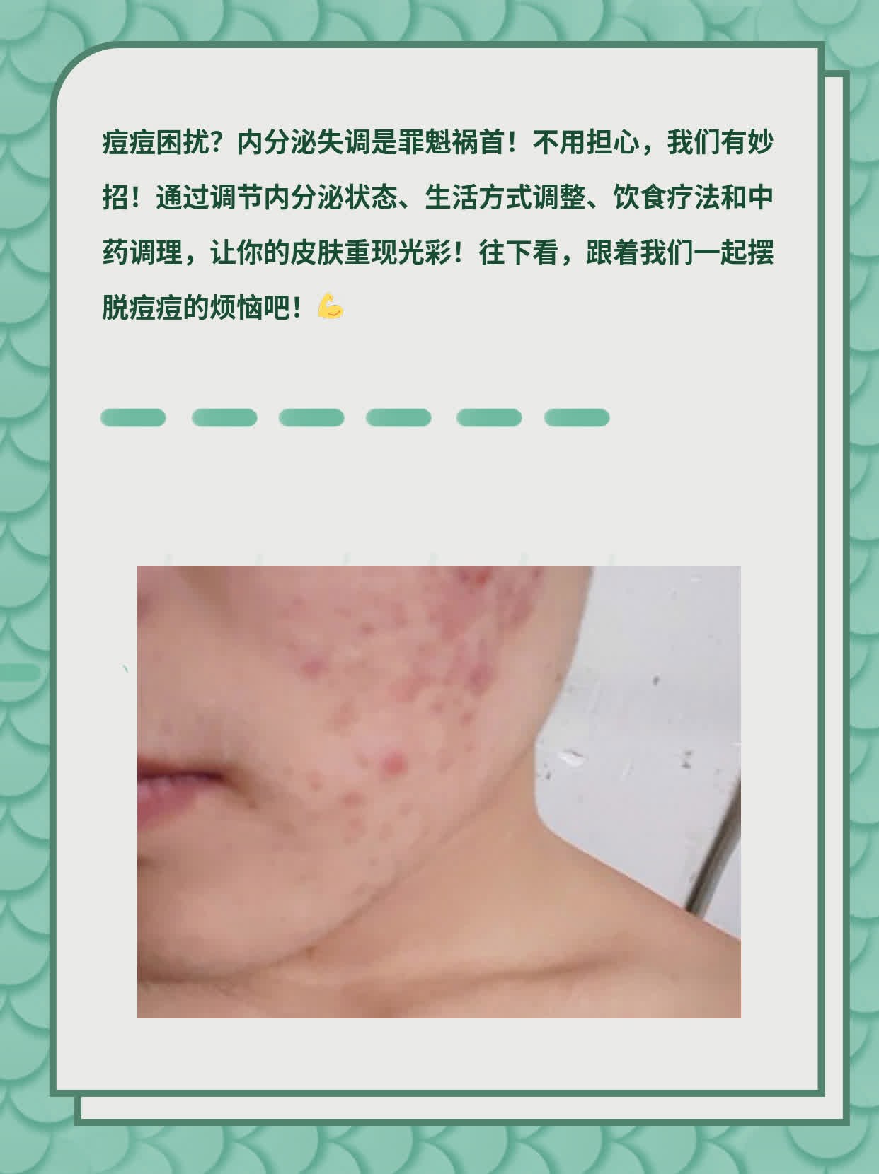 「内分泌失调+长痘痘」这样治！