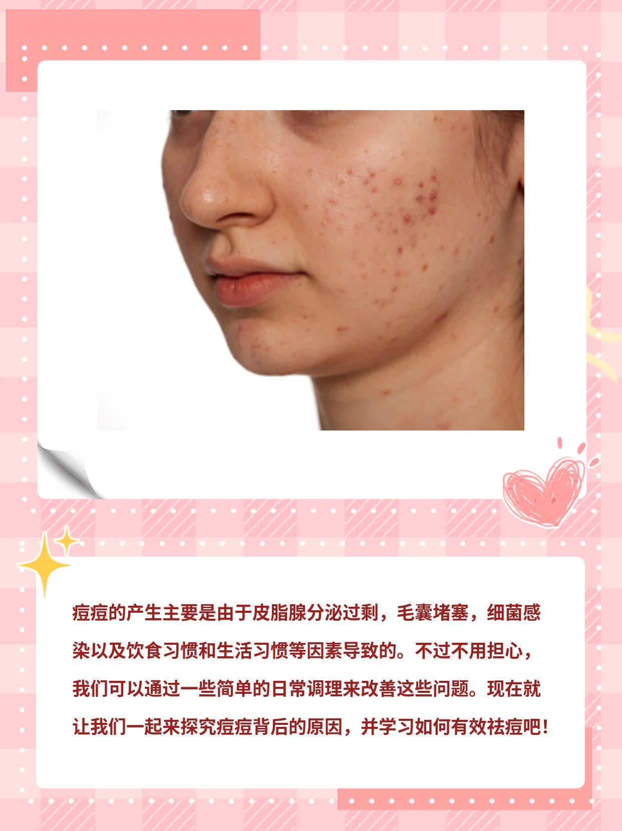 祛痘秘籍：探究痘痘背后的原因！