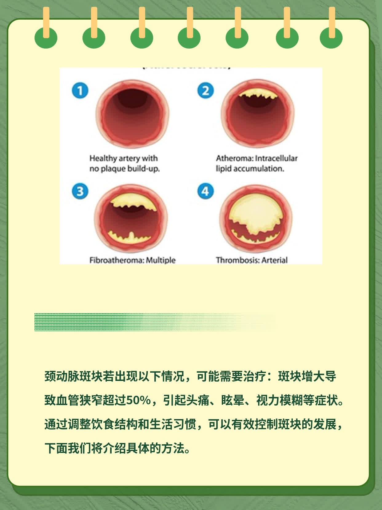 「这招」识破颈动脉斑块是否需治疗