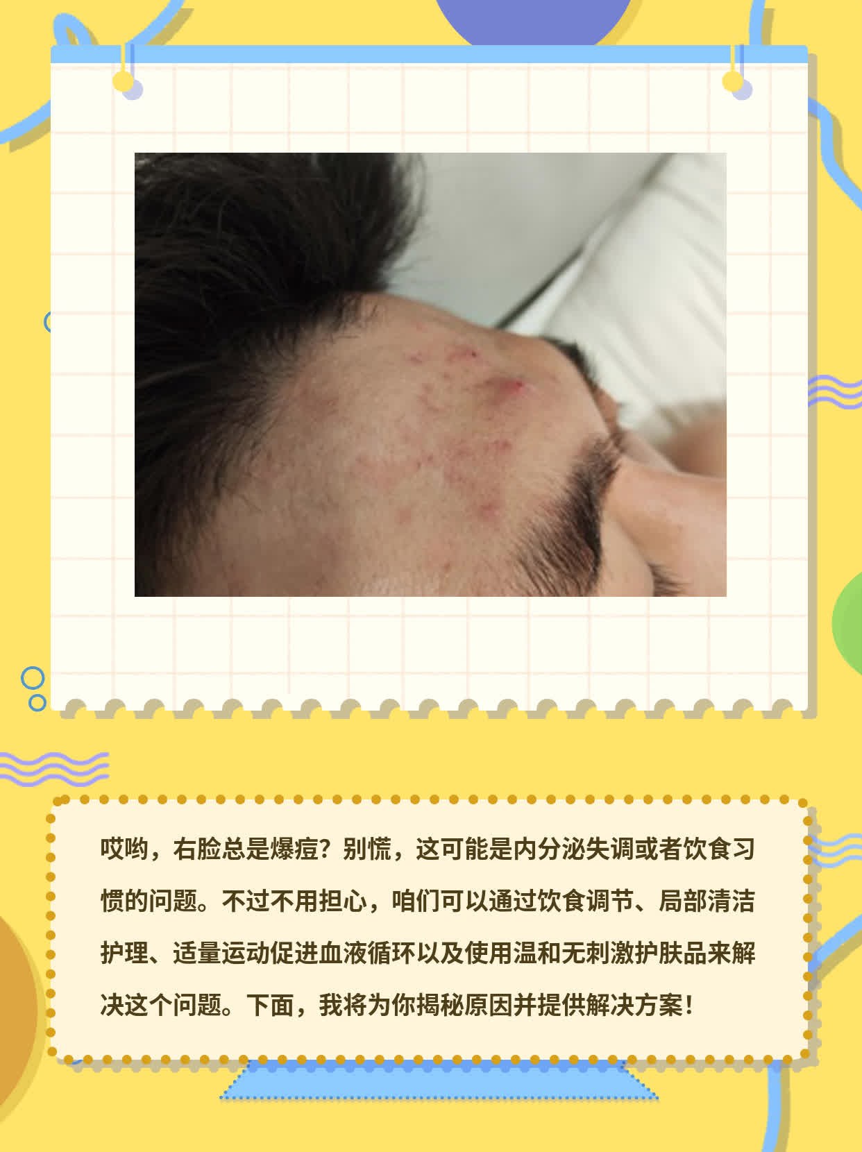 「右脸反复长痘」：揭秘原因及解决方案！