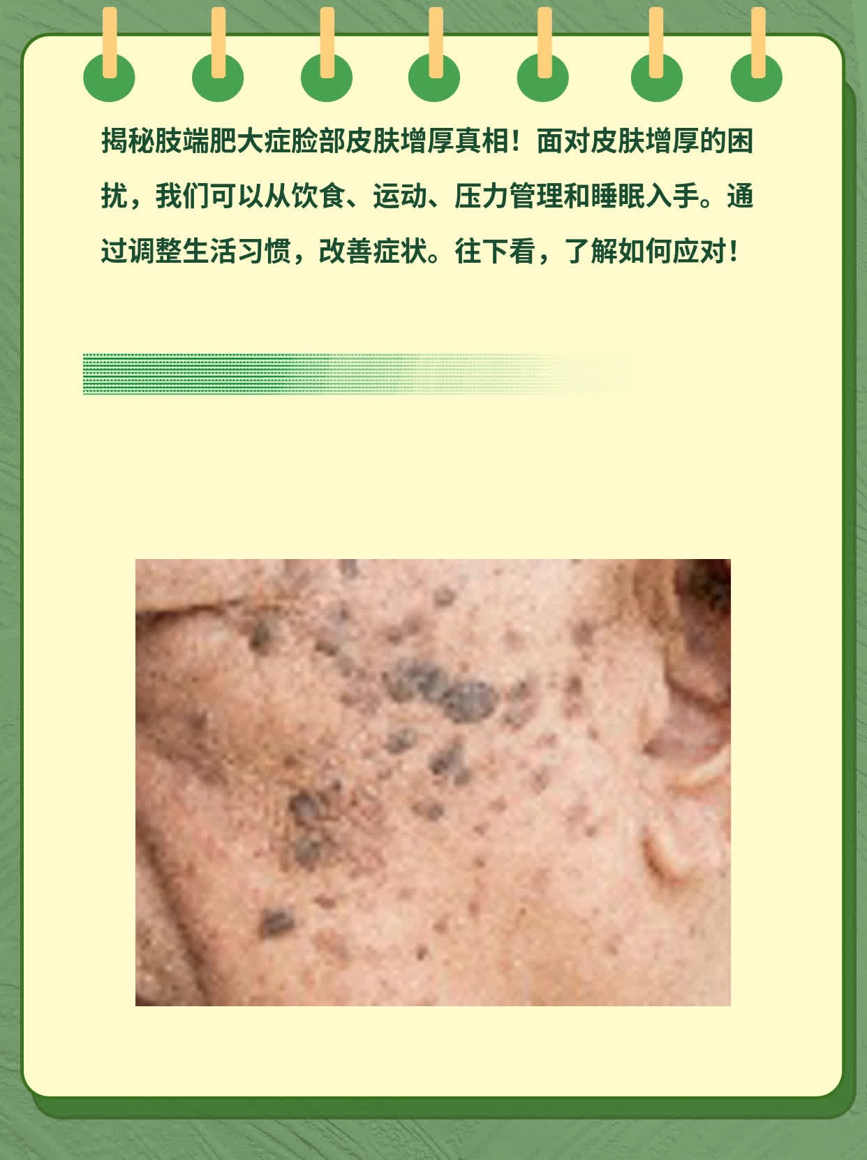 「揭秘」肢端肥大症脸部皮肤增厚真相！