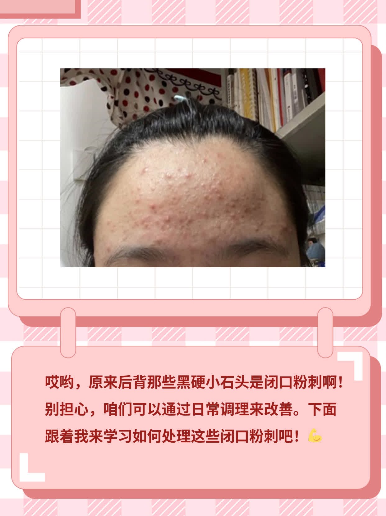 揭秘：后背黑硬小石头竟是闭口粉刺？！