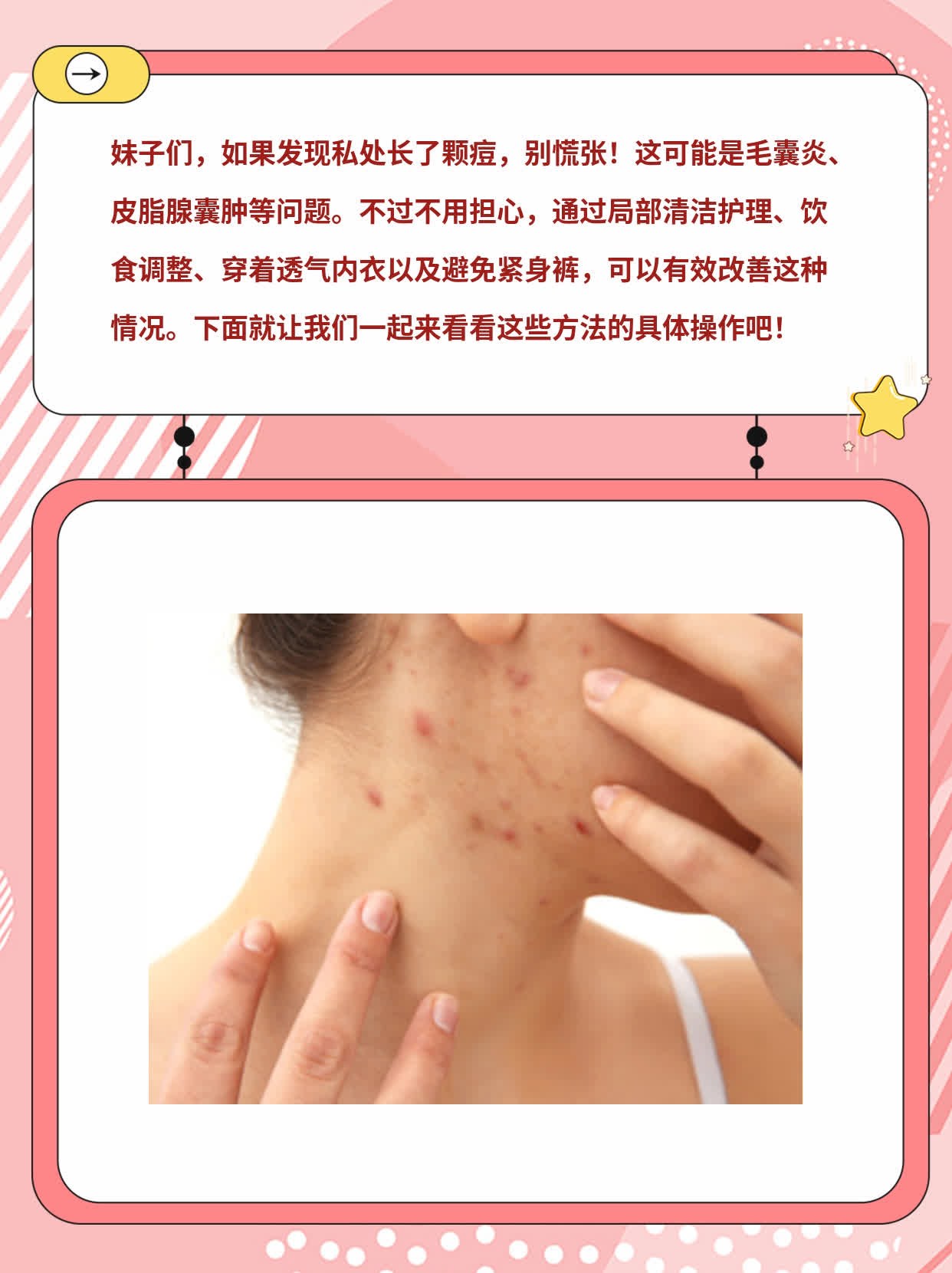 「有图」女生私处长痘原因大揭秘！