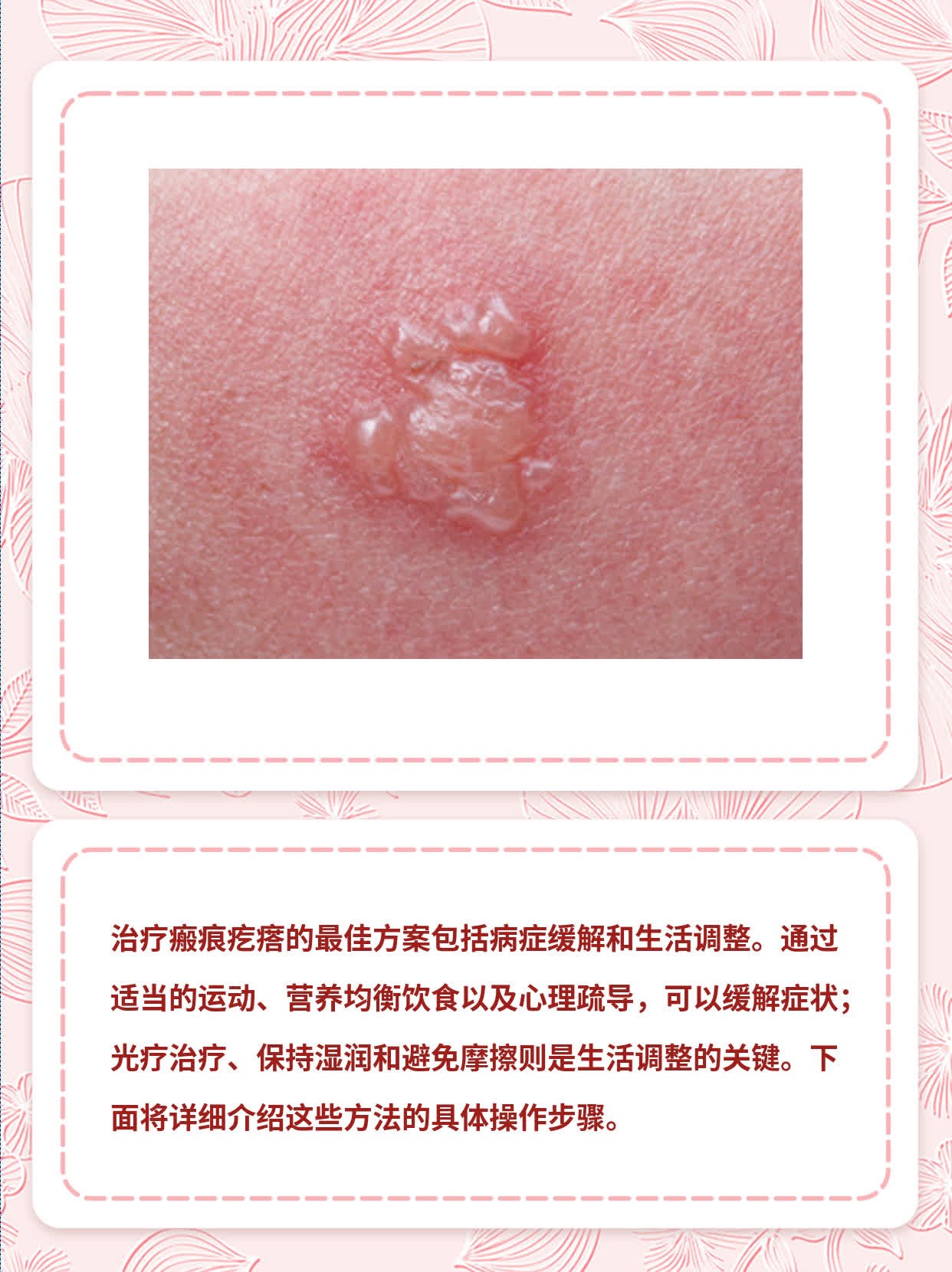 「经验分享」治疗瘢痕疙瘩的最佳方案探秘