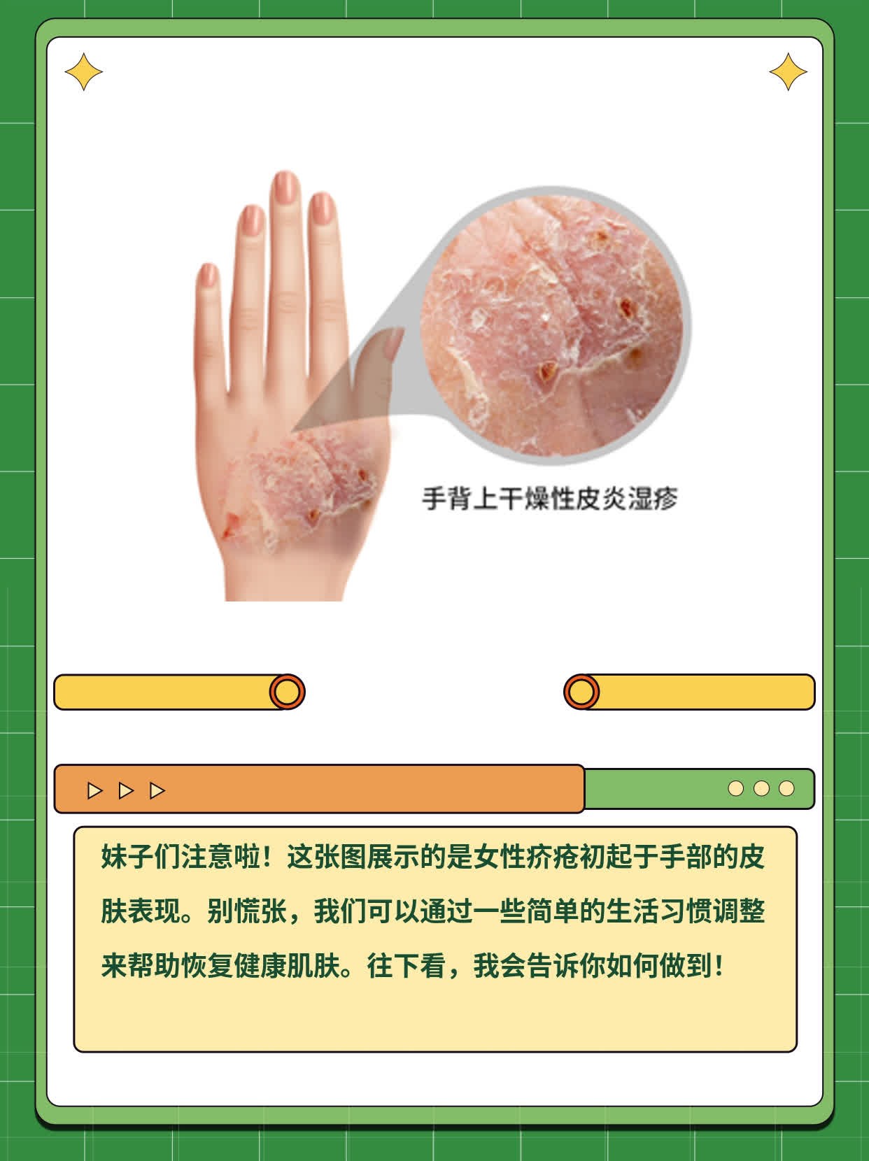 一图看懂：女性疥疮初起于手部的皮肤表现