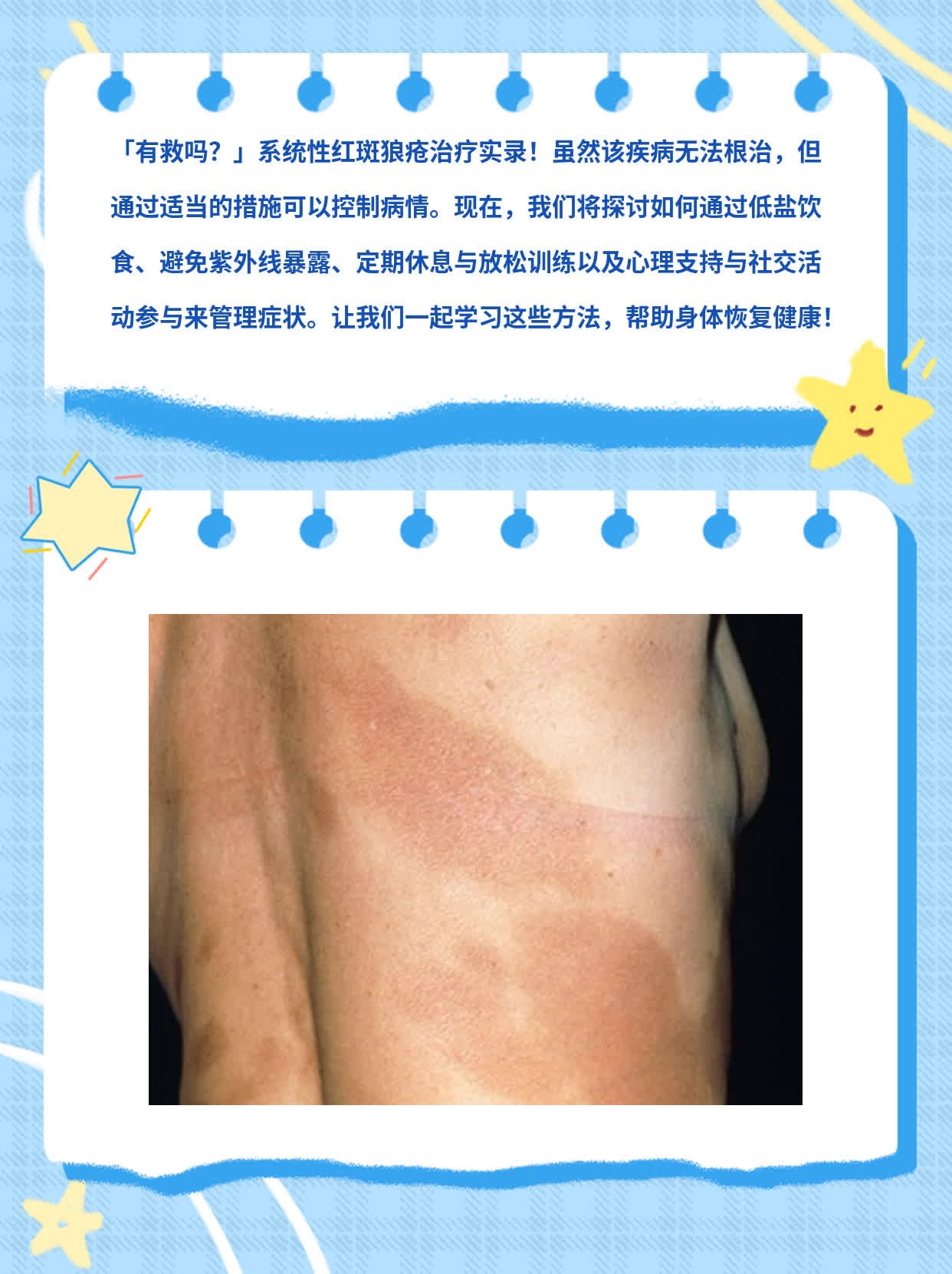 「有救吗？」系统性红斑狼疮治疗实录