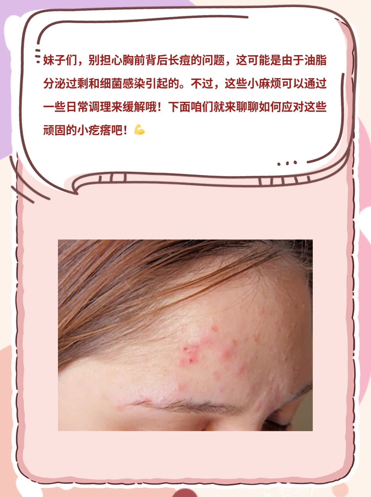 「女生胸前背后长痘」原因揭秘！