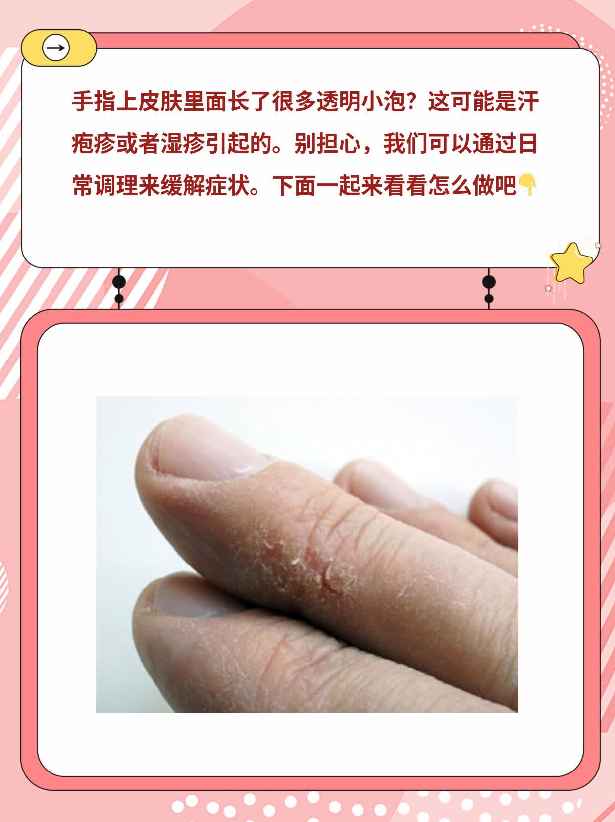 手指起透明小泡？揭秘背后原因及处理妙招！